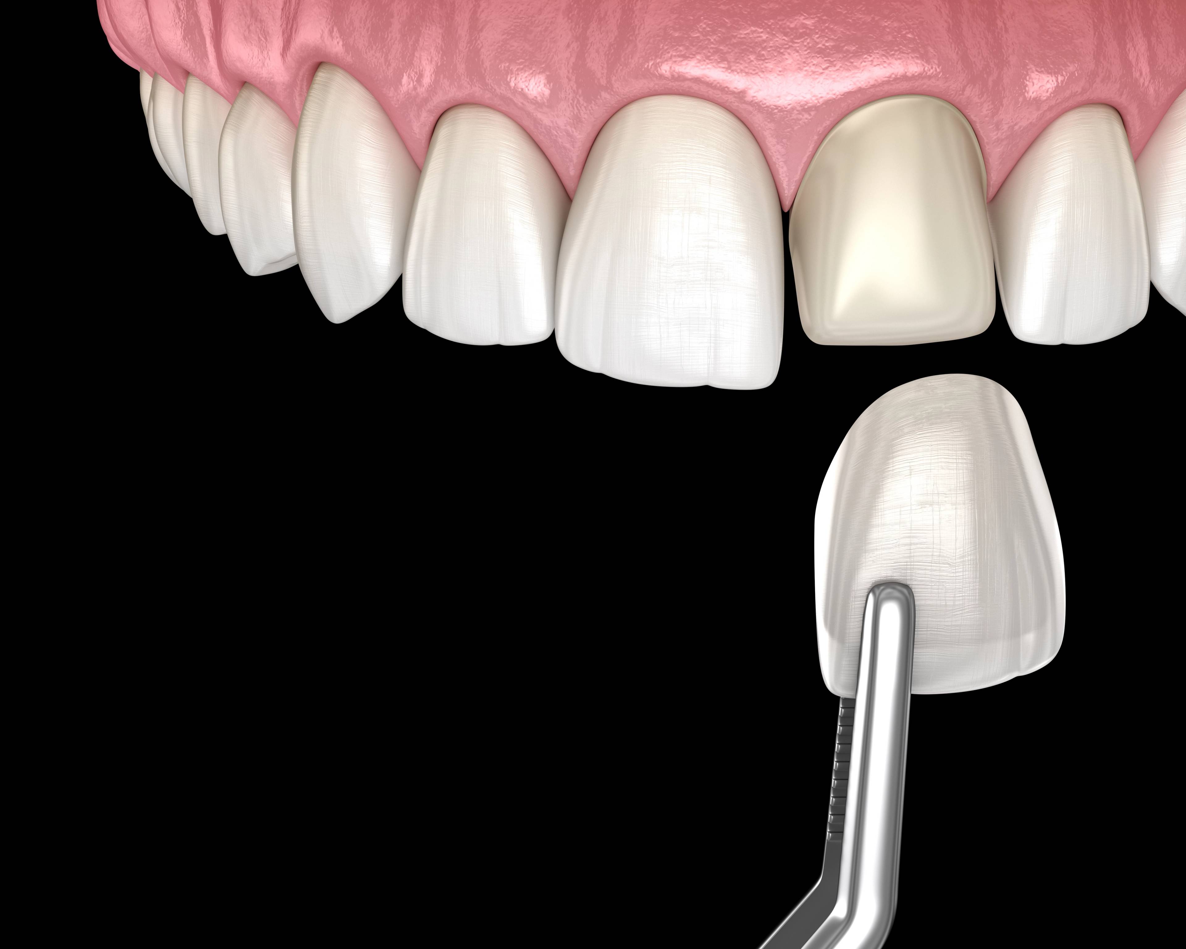 model of thin porcelain veneer being placed on front tooth