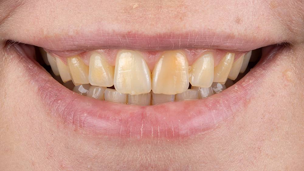 Before tooth whitening treatment teeth with dark yellow staining
