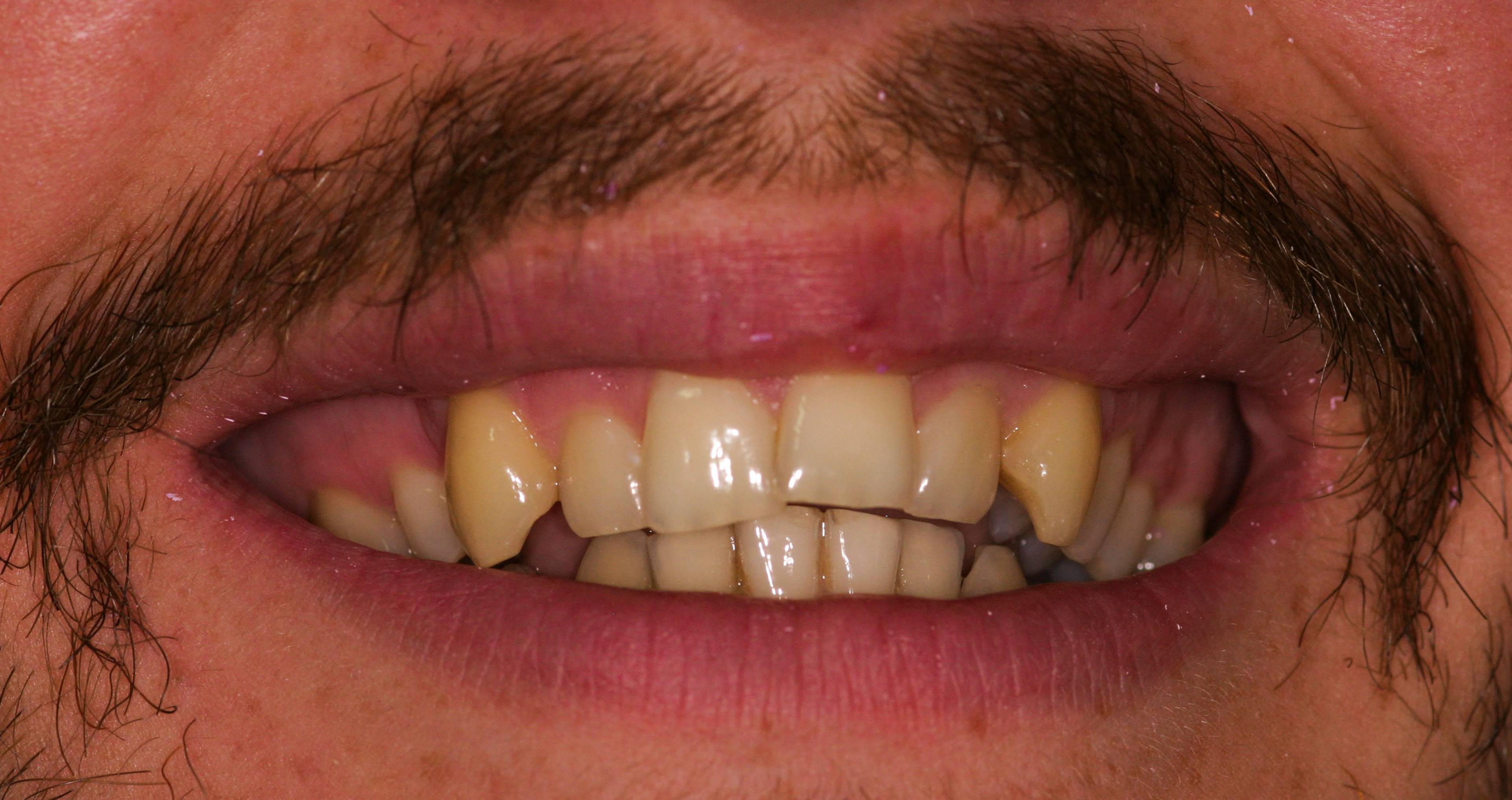 Before composite bonding showing gaps and discoloured teeth