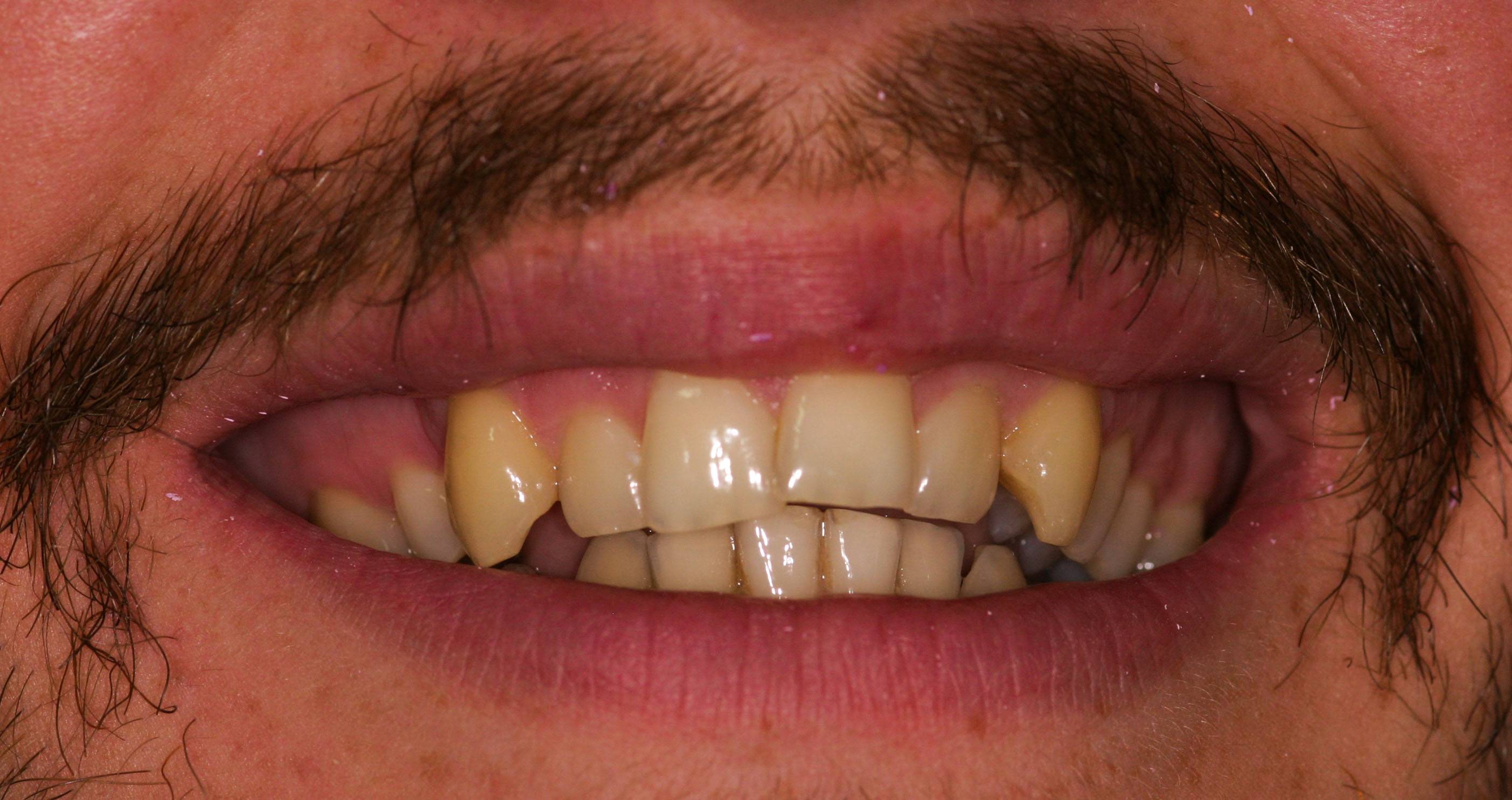 Before composite bonding showing gaps and discoloured teeth