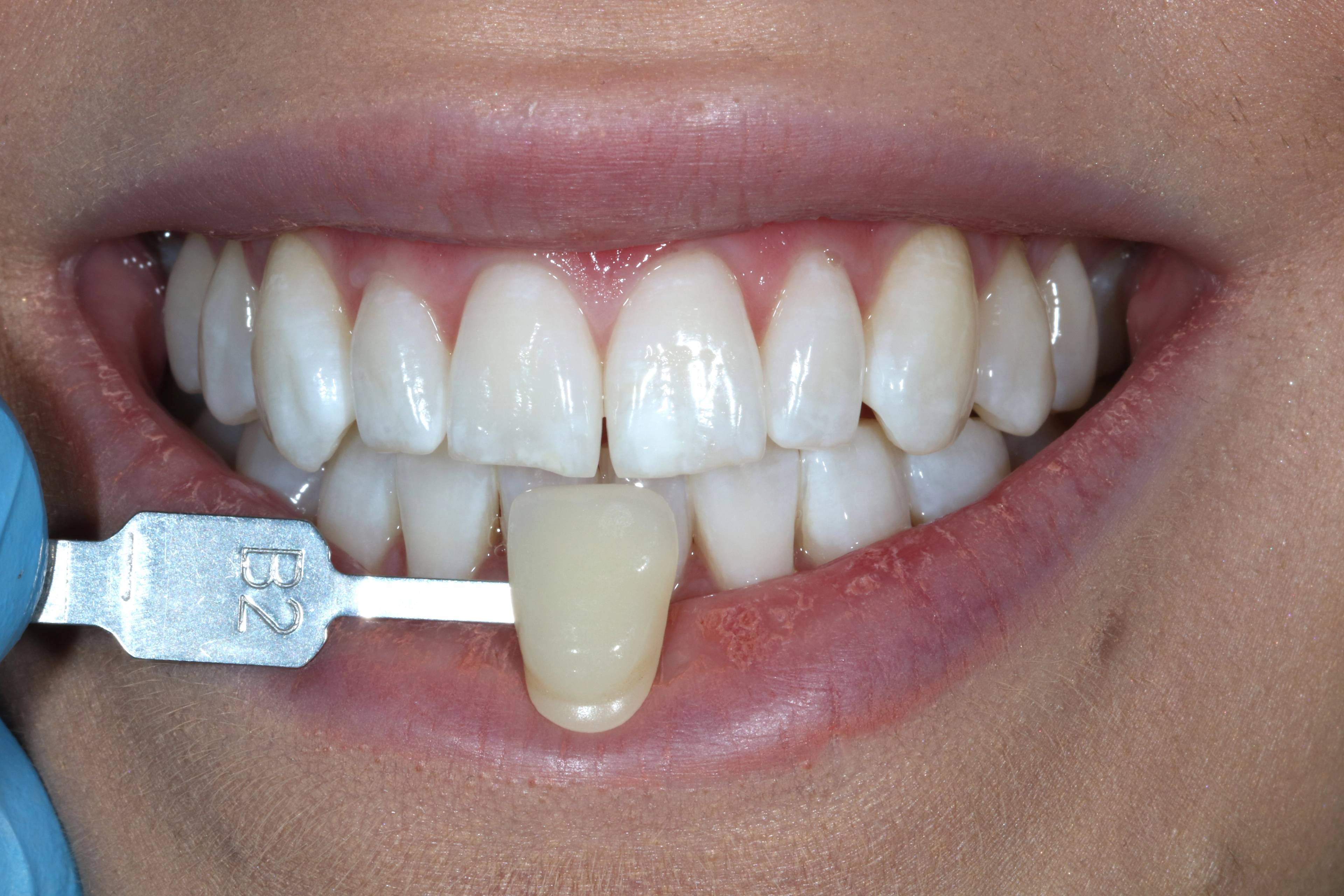 after tooth whitening showing a lighter shade that B2