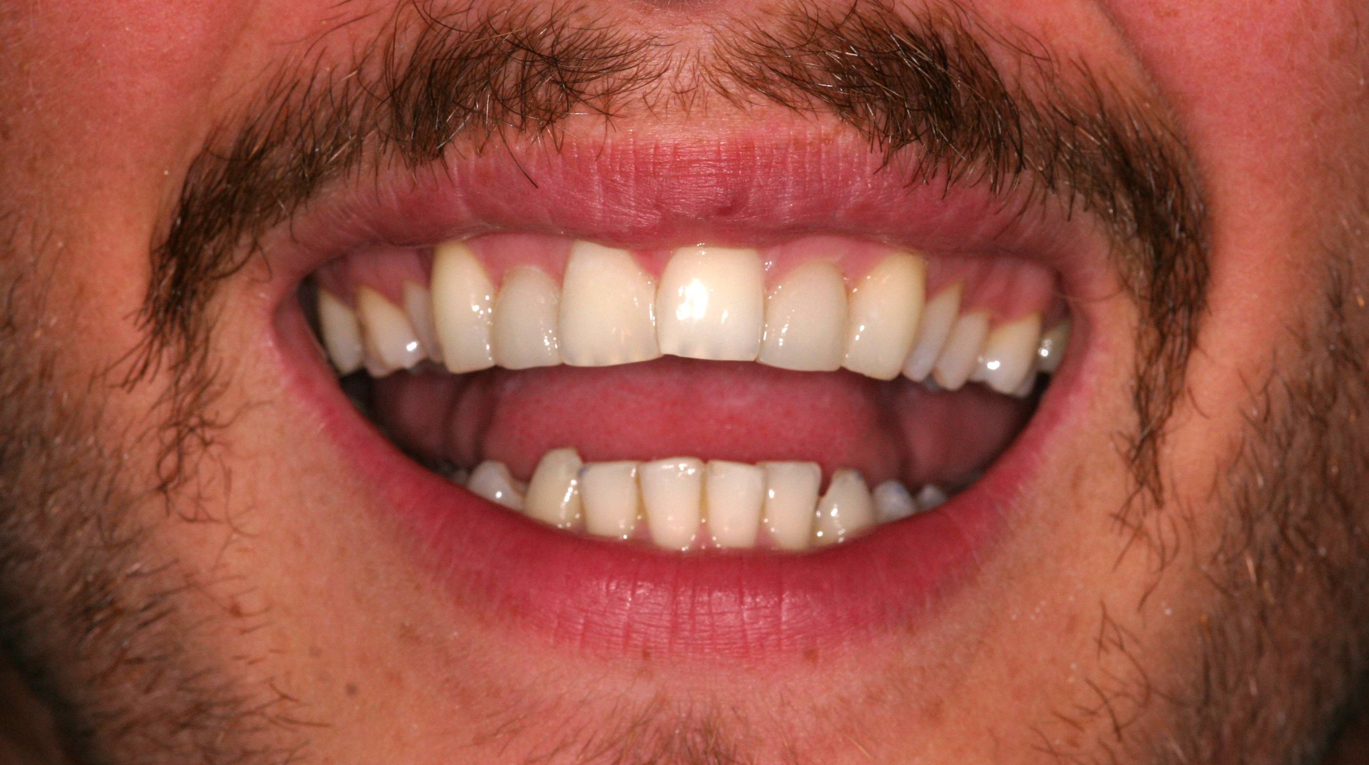After composite bonding showing a bright smile and aligned teeth