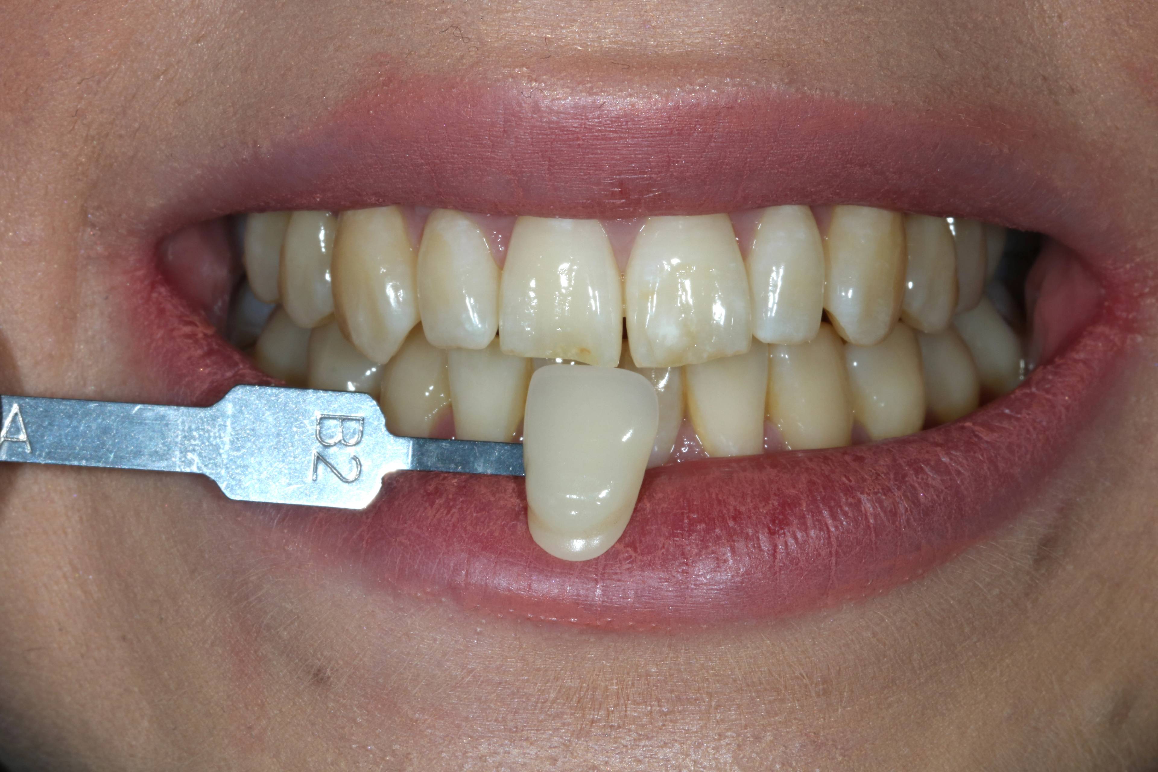 before tooth whitening treatment smile slightly stained with colour B2 