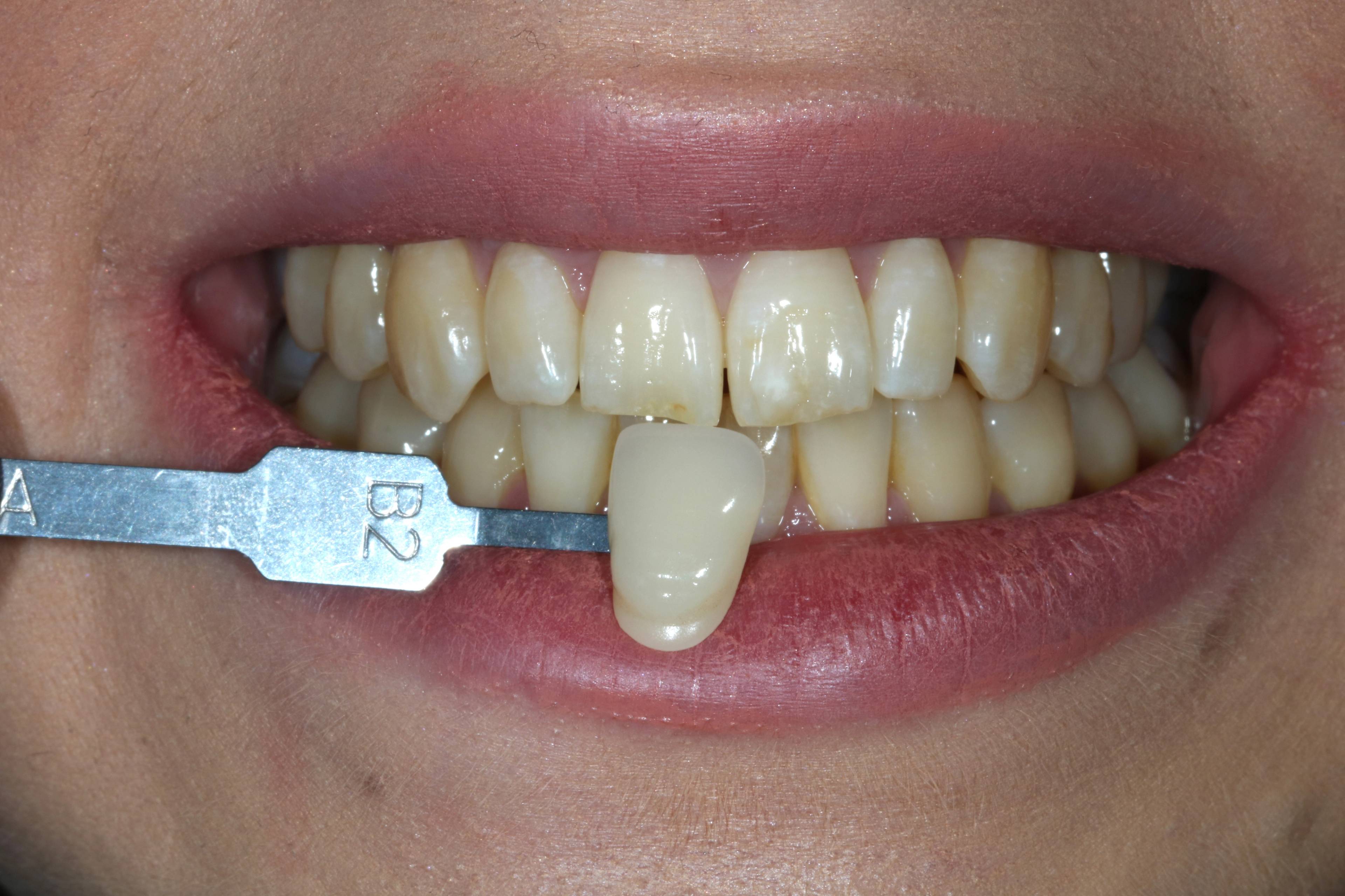 before tooth whitening treatment smile slightly stained with colour B2