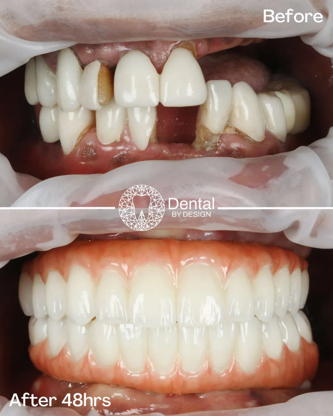 Bone Grafting for Dental Implants: What It Is, Why You Might Need It, and What to Expect 