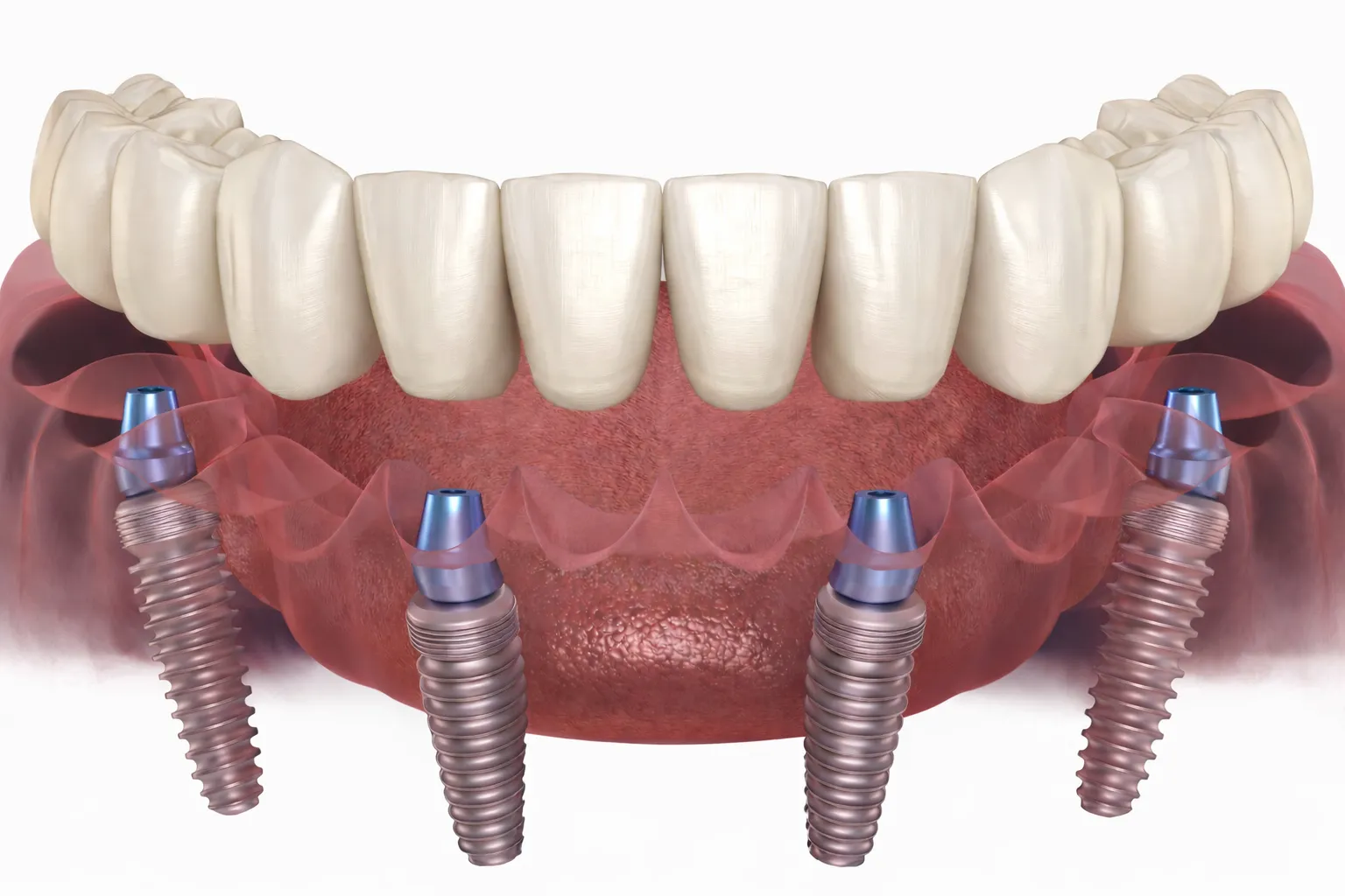 All-on-4 Dental Implants Explained: What It Is, What It Isn’t, and What to Ask