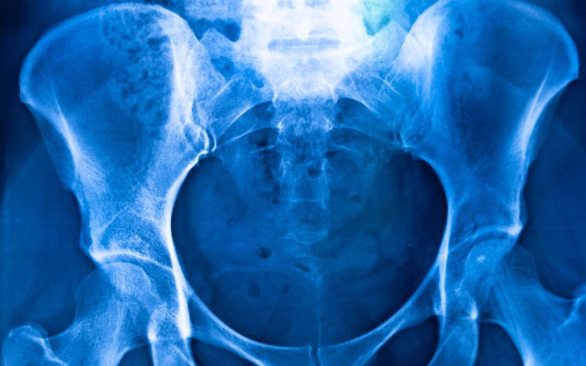 Pelvis x ray for brachytherapy