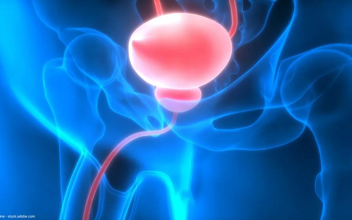 Prostate Artery Embolization (PAE)