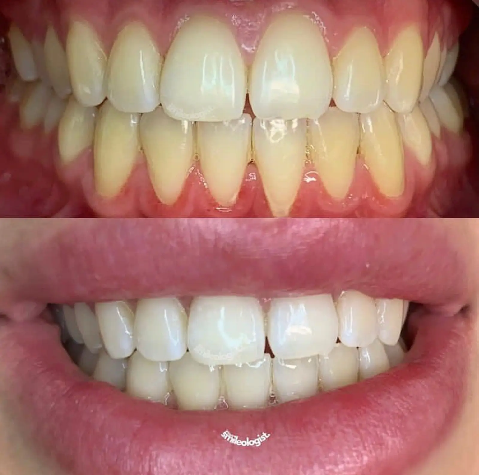 Teeth whitening consultation