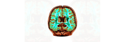 Tomografía por emisión de positrones (PET) en la atención de la enfermedad de Alzheimer: la perspectiva europea
