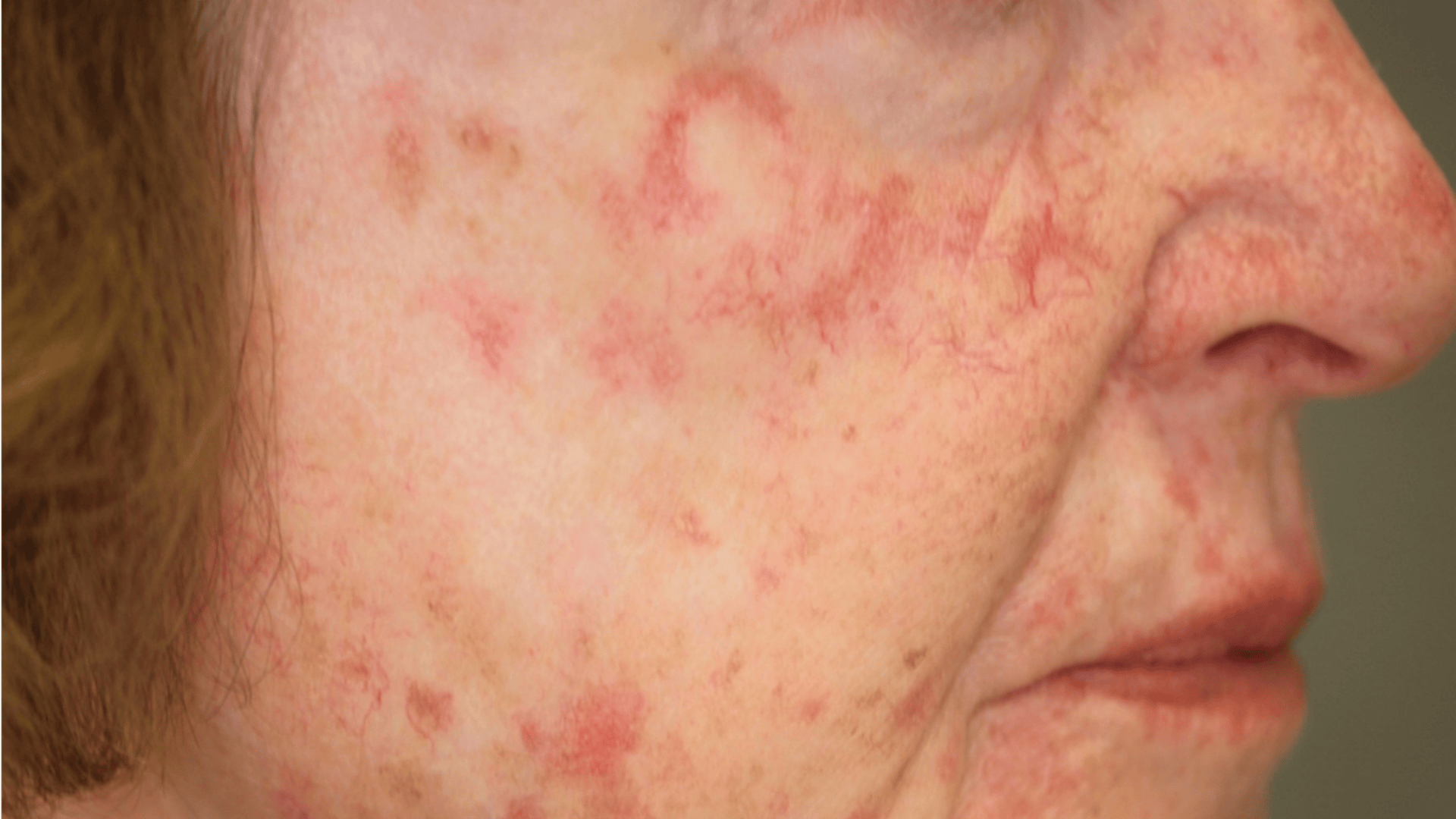 Topical therapies play a crucial role in both managing and preventing AK