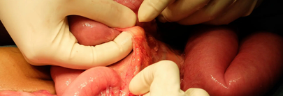 Adherencias peritoneales: prevención y tratamiento