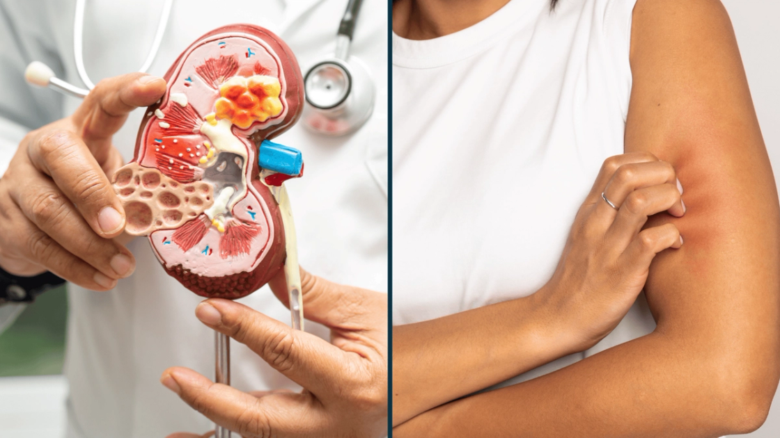 Understanding Chronic Kidney Disease Pruritus