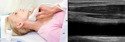 Ecografía vascular en la revaluación del riesgo cardiovascular