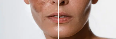 Hyperpigmentation management: treatments, procedures and role of dermocosmetics