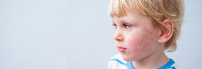 Dermatología pediátrica: problemas frecuentes