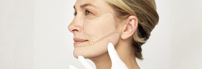 Injections of Hyaluronic Acid products in the mid- and lower- third: are there any safe zones?