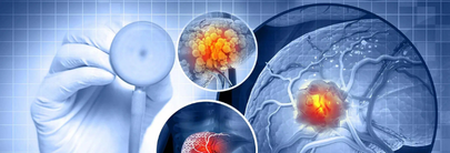 Management of Hepatocellular Carcinoma (HCC) in Cirrhotic Patients