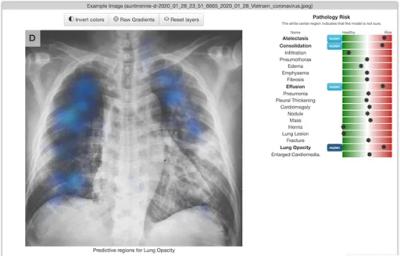 Chester the AI Radiology Assistant