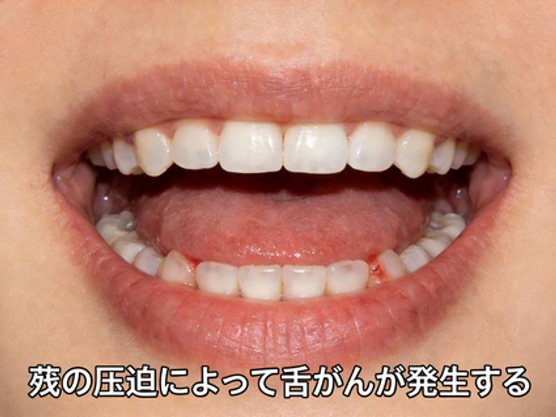 喫煙や飲酒の習慣がない若い世代で舌癌が増えていると聞くと、驚かれるかもしれません。原因の一つとして、「狭い歯列」が挙げられています。