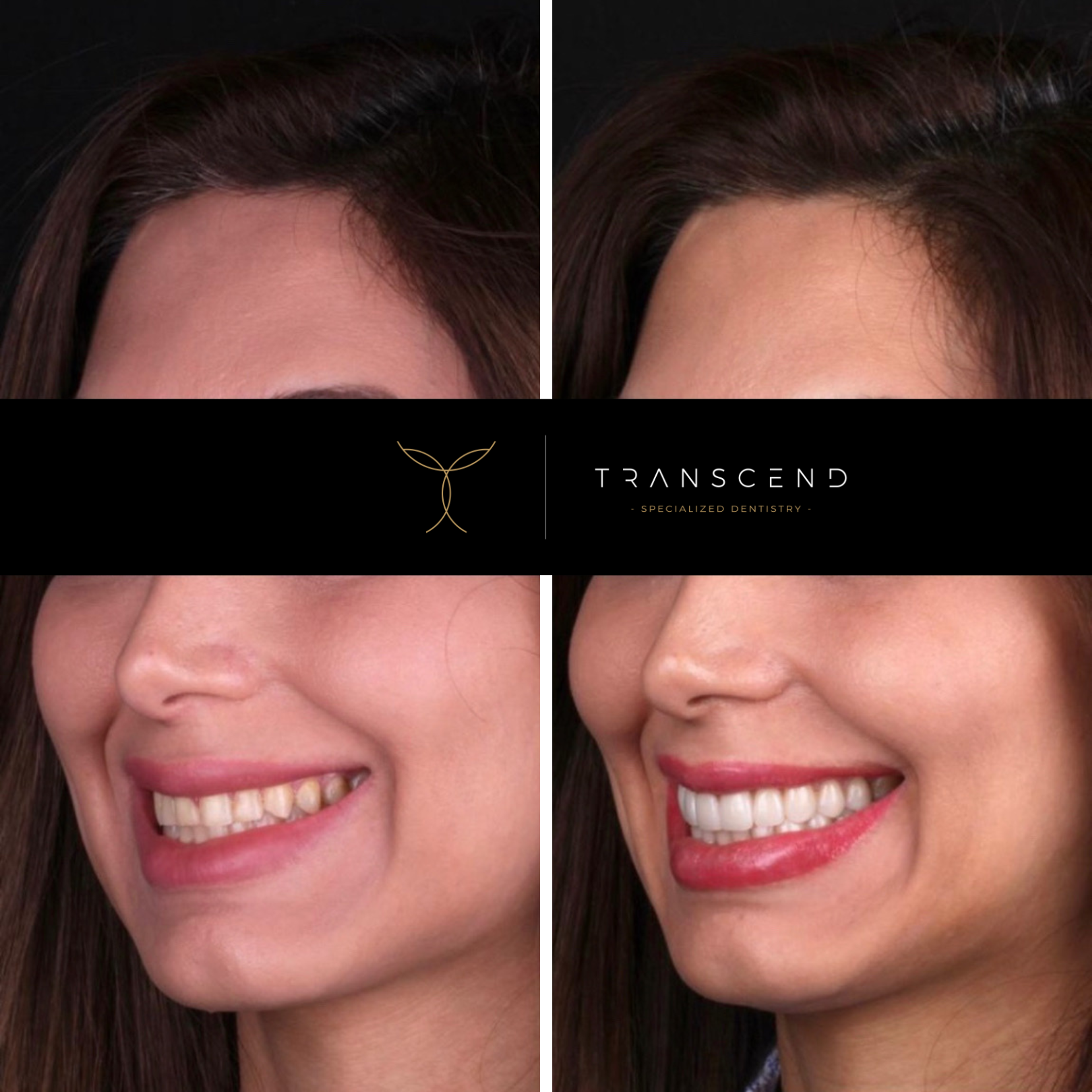 Before and after portraits of a female patient who had veneers made and placed.