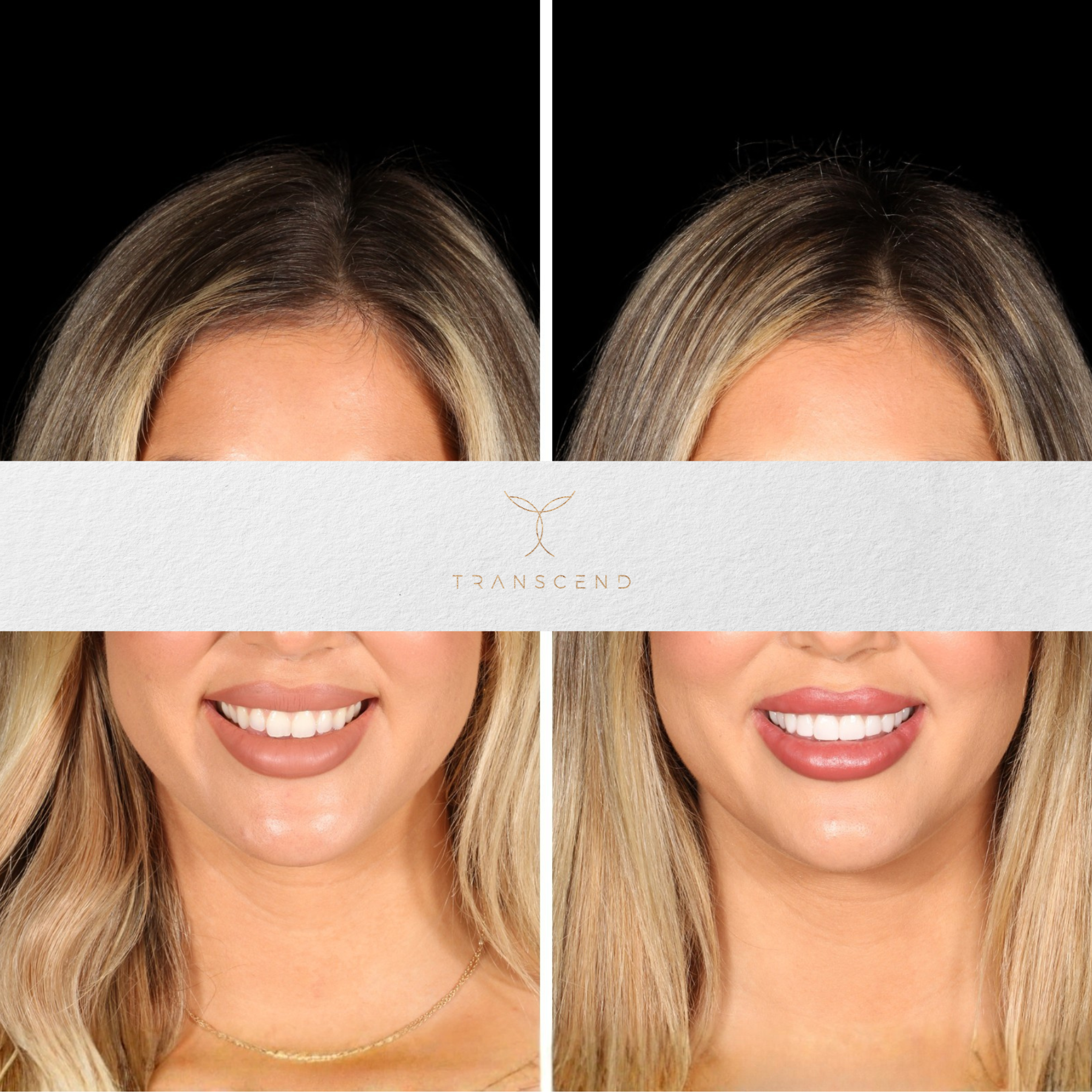 Smile Transformation 8