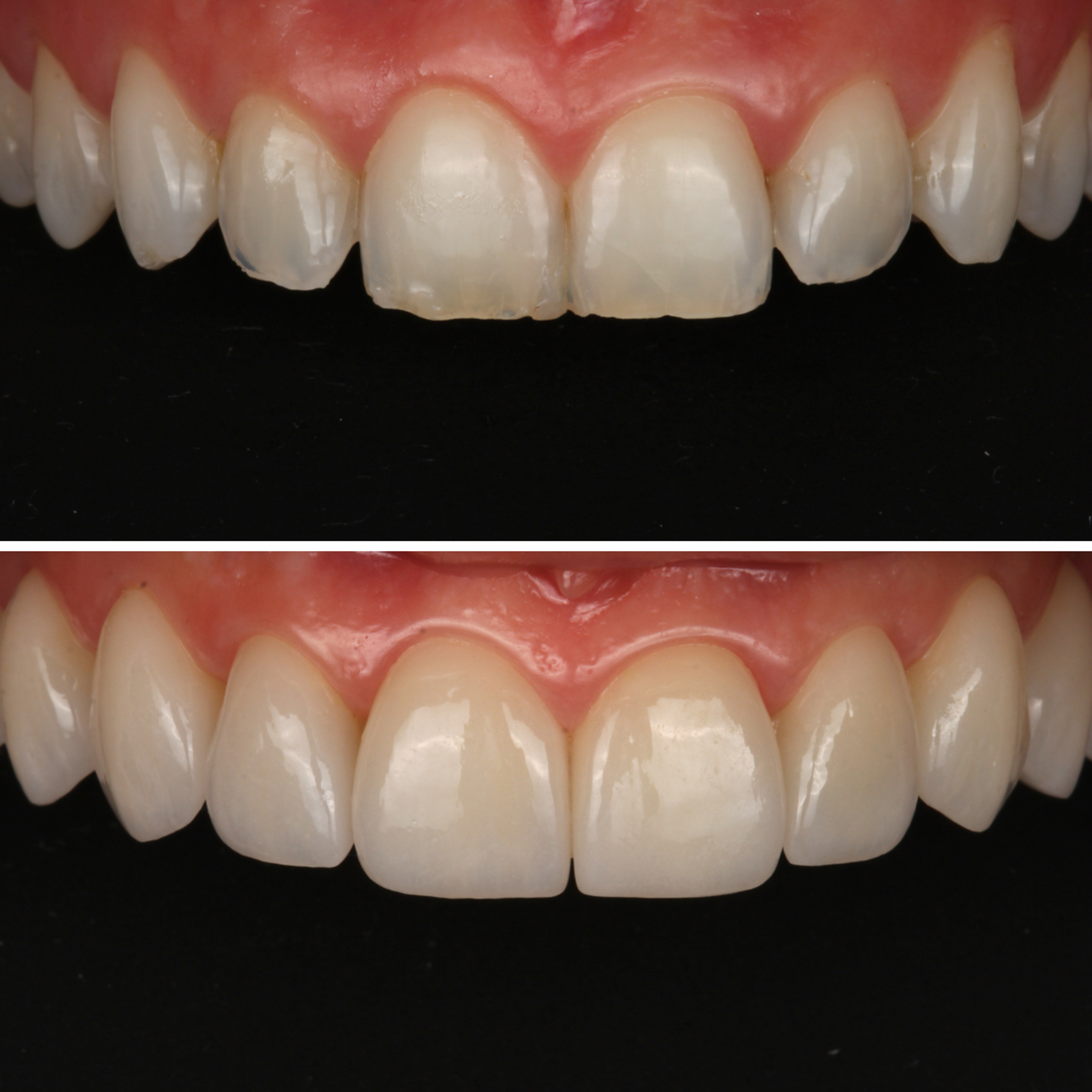 No-Prep Porcelain Veneers before and after - porcelain veneers Vancouver - Transcend Dentistry