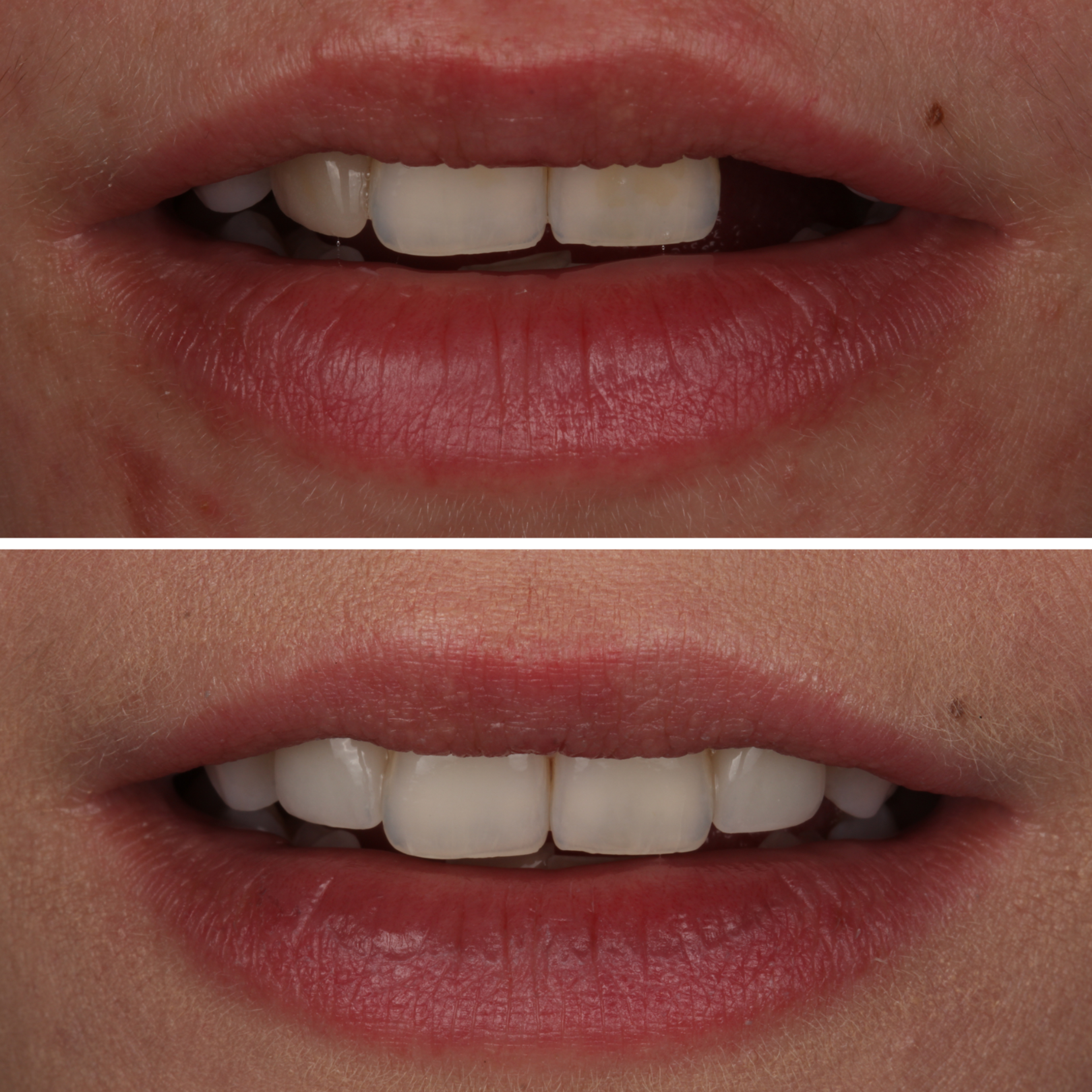 Anterior Restoration — before and after
