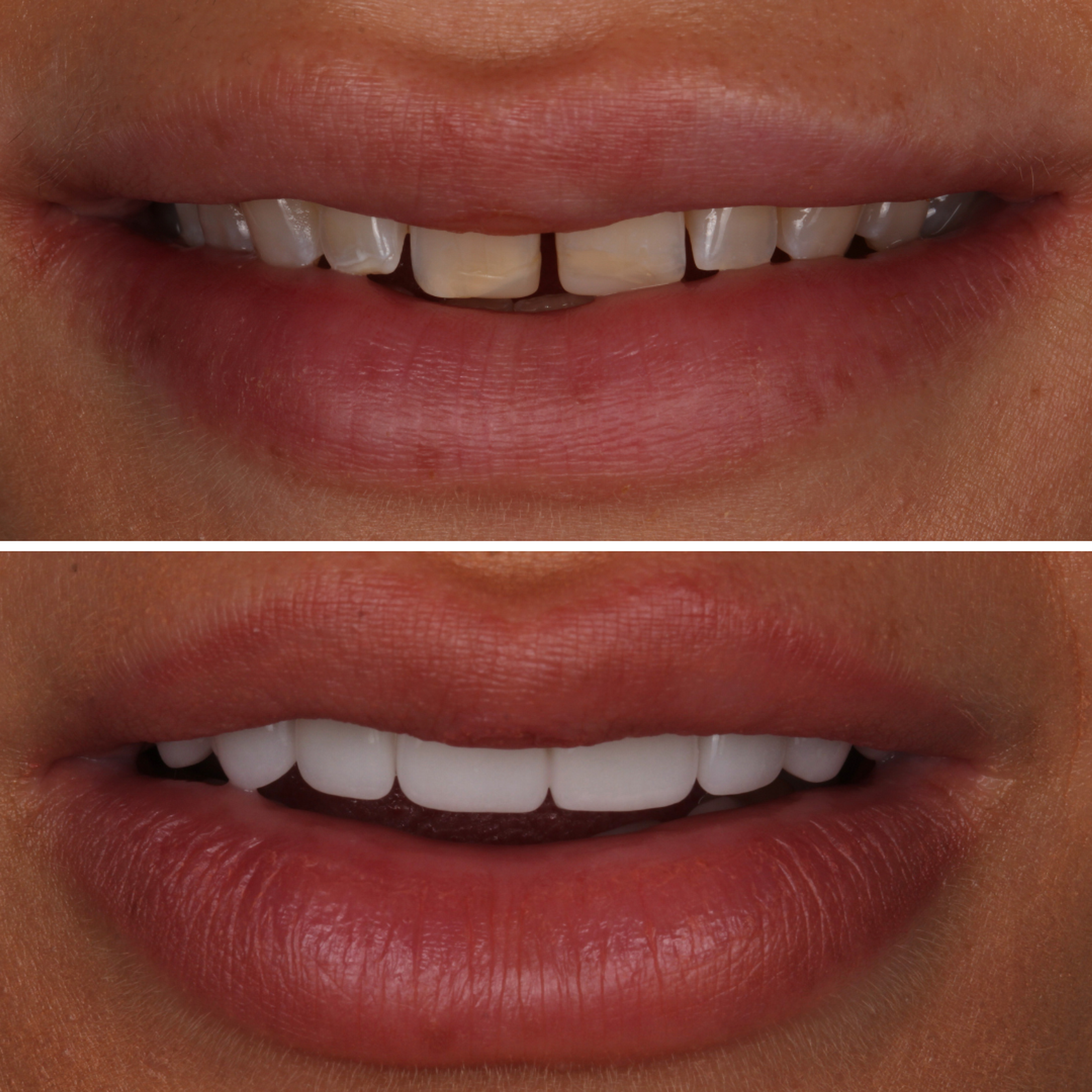 No-Prep Veneers — Full Smile before and after - porcelain veneers Vancouver - Transcend Dentistry