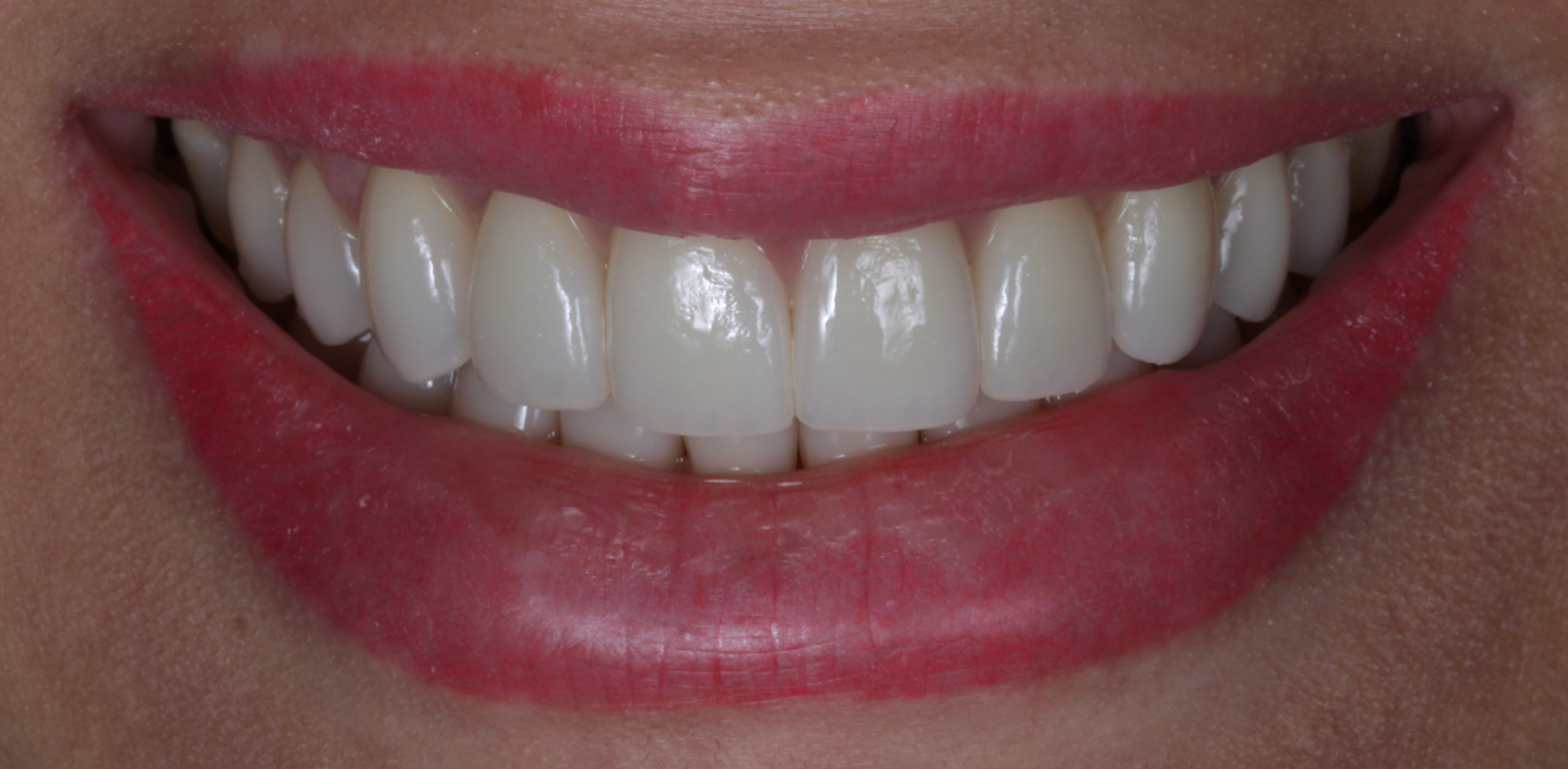 The same smile after a minimal-prep porcelain veneer makeover at Transcend — bright, balanced teeth in natural proportion with the lips