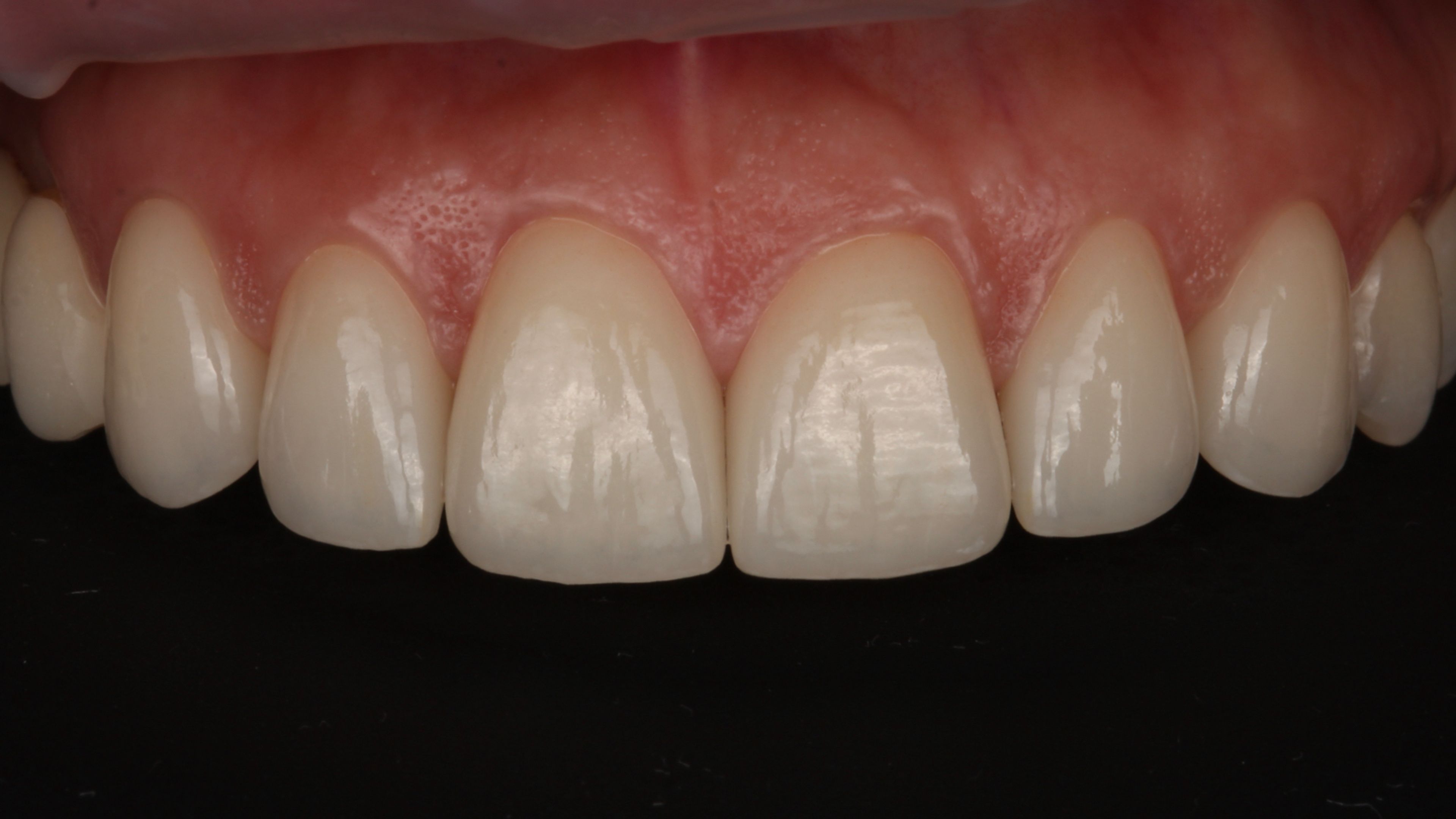Final result after the porcelain veneers were bonded