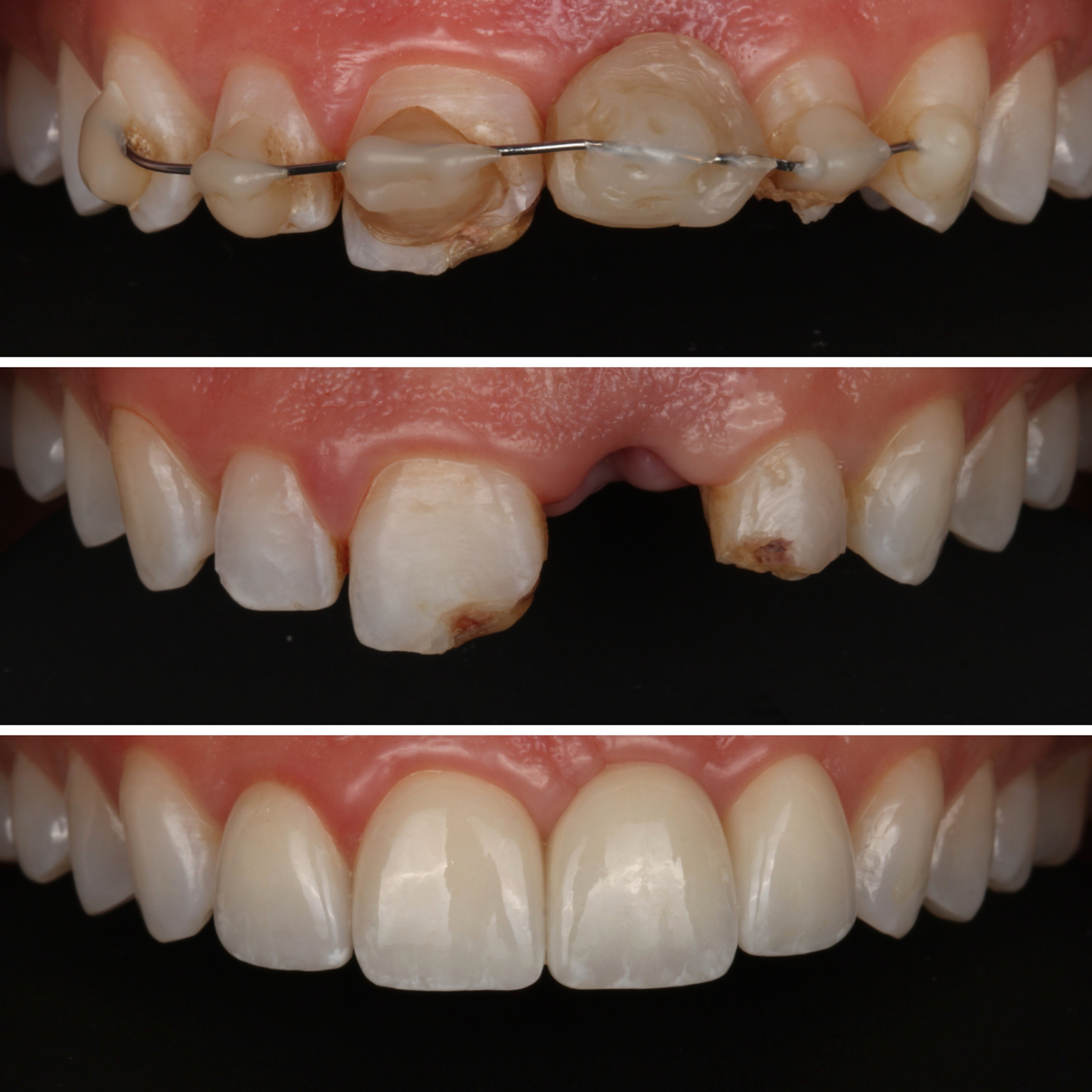 Dental Implants before and after — specialist dental care at Transcend Dentistry Vancouver