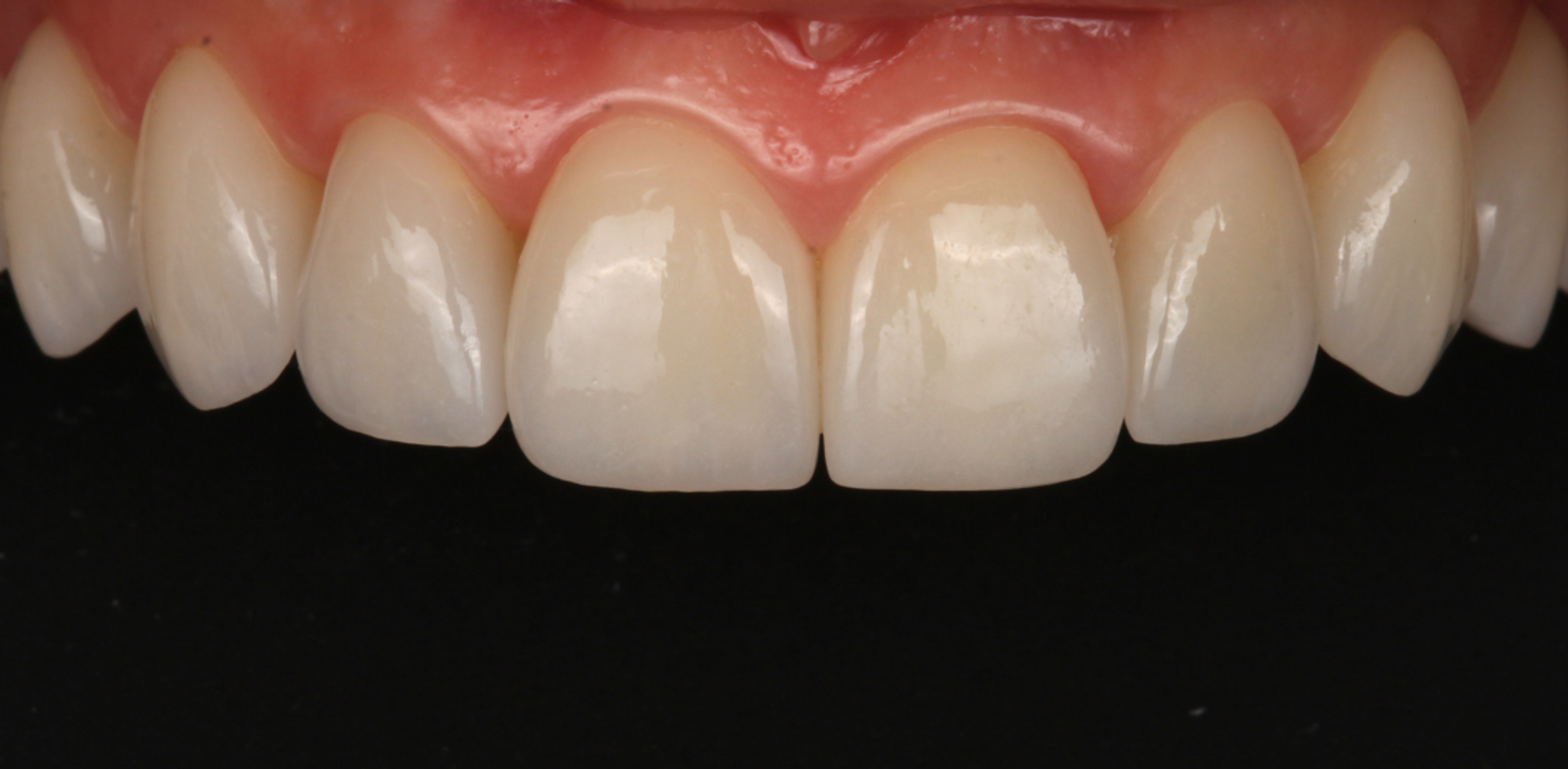 Close-up of the same teeth after porcelain veneers crafted in the Transcend lab — natural translucency at the edges and clean, healthy gum margins