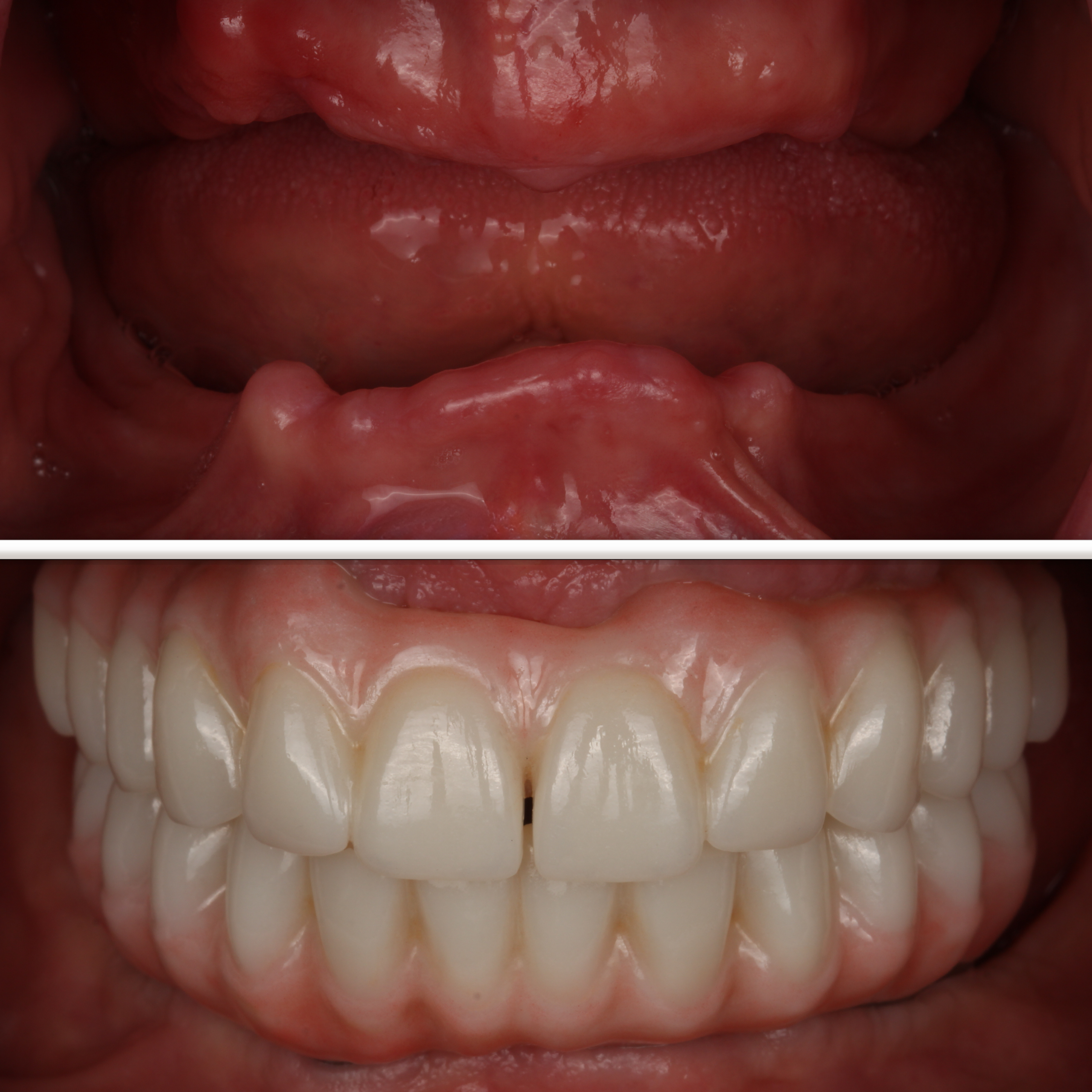 Full arch implants for edentulous patient — before and after