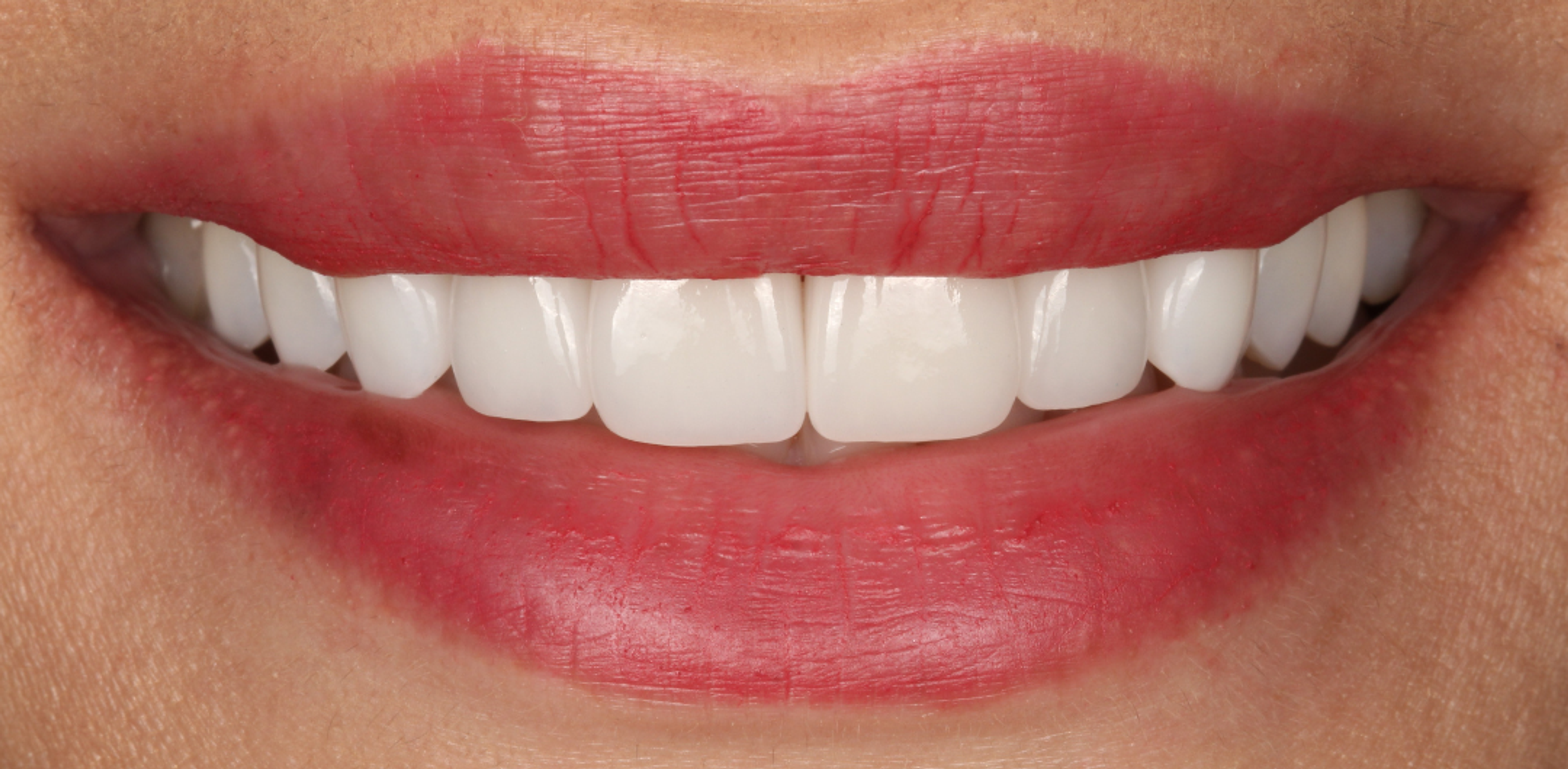The same smile after porcelain veneers at Transcend — an unmistakably bright white smile framed by bright red lips