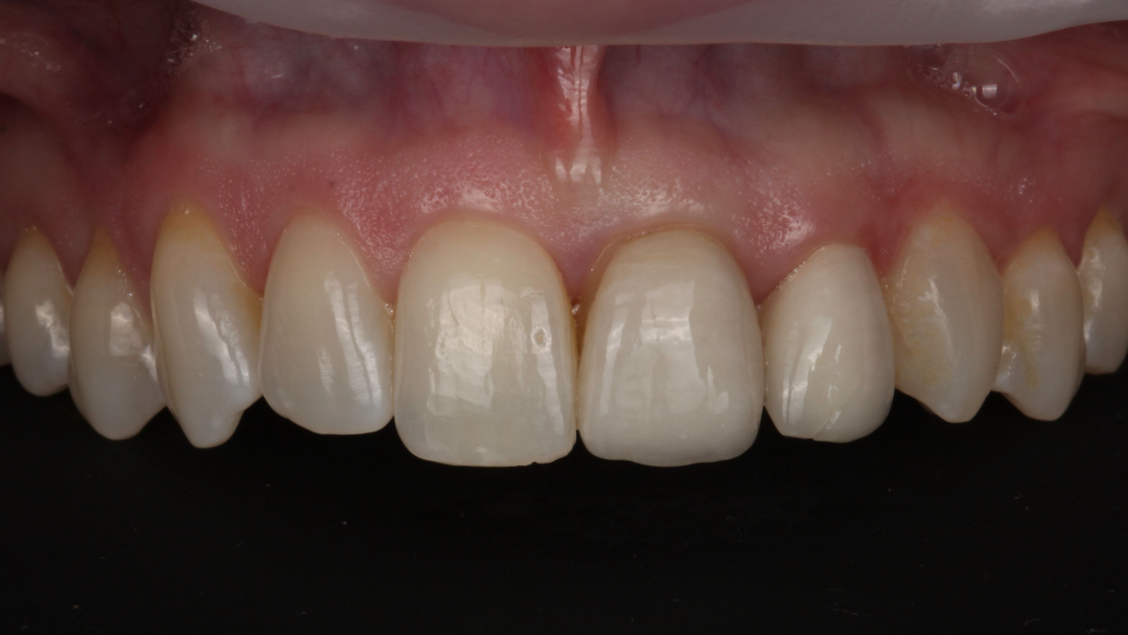 Two porcelain veneers on the upper left central and lateral incisors — visible margin lines between the porcelain and the underlying tooth, and a crack through one of the veneers