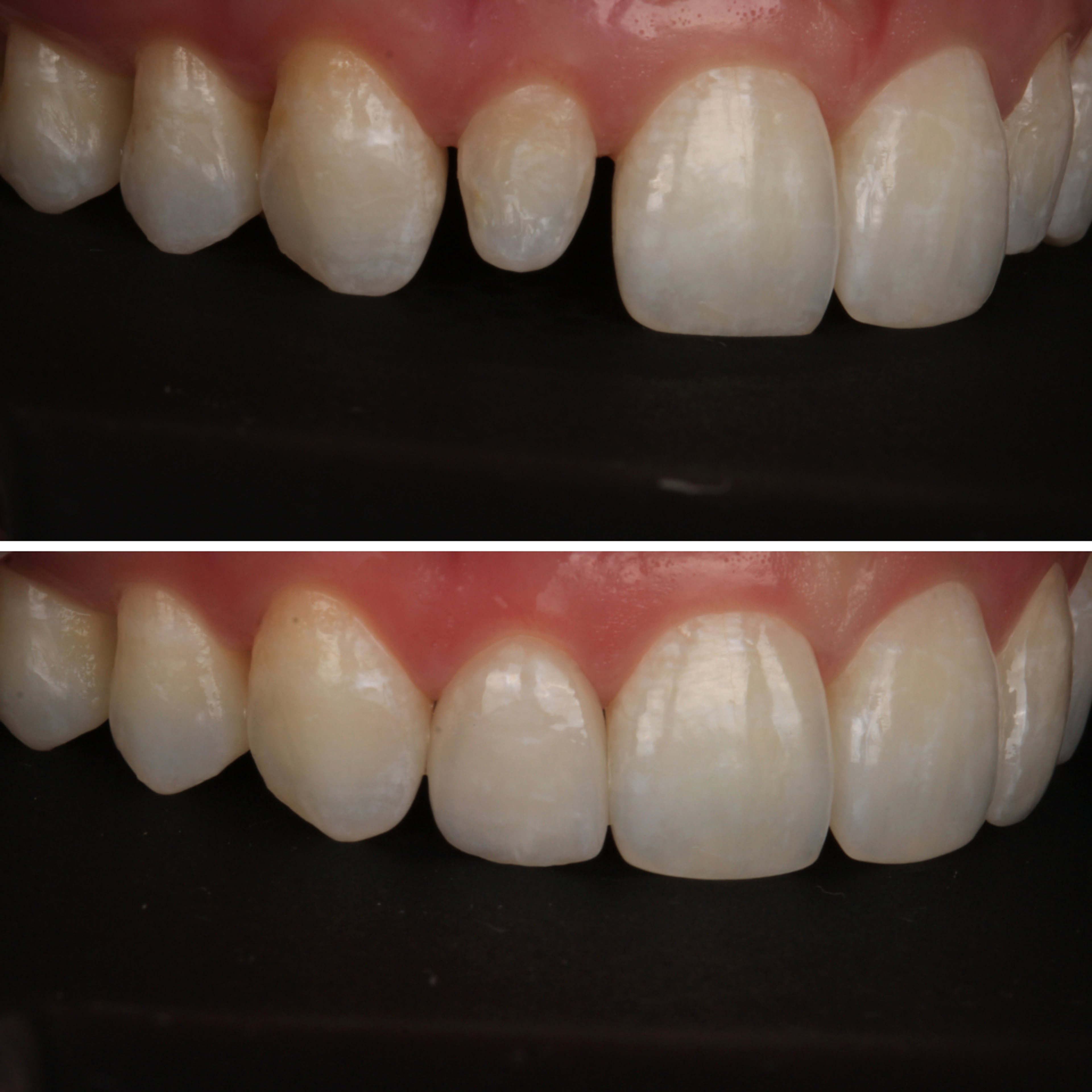 Single Anterior Tooth — before and after