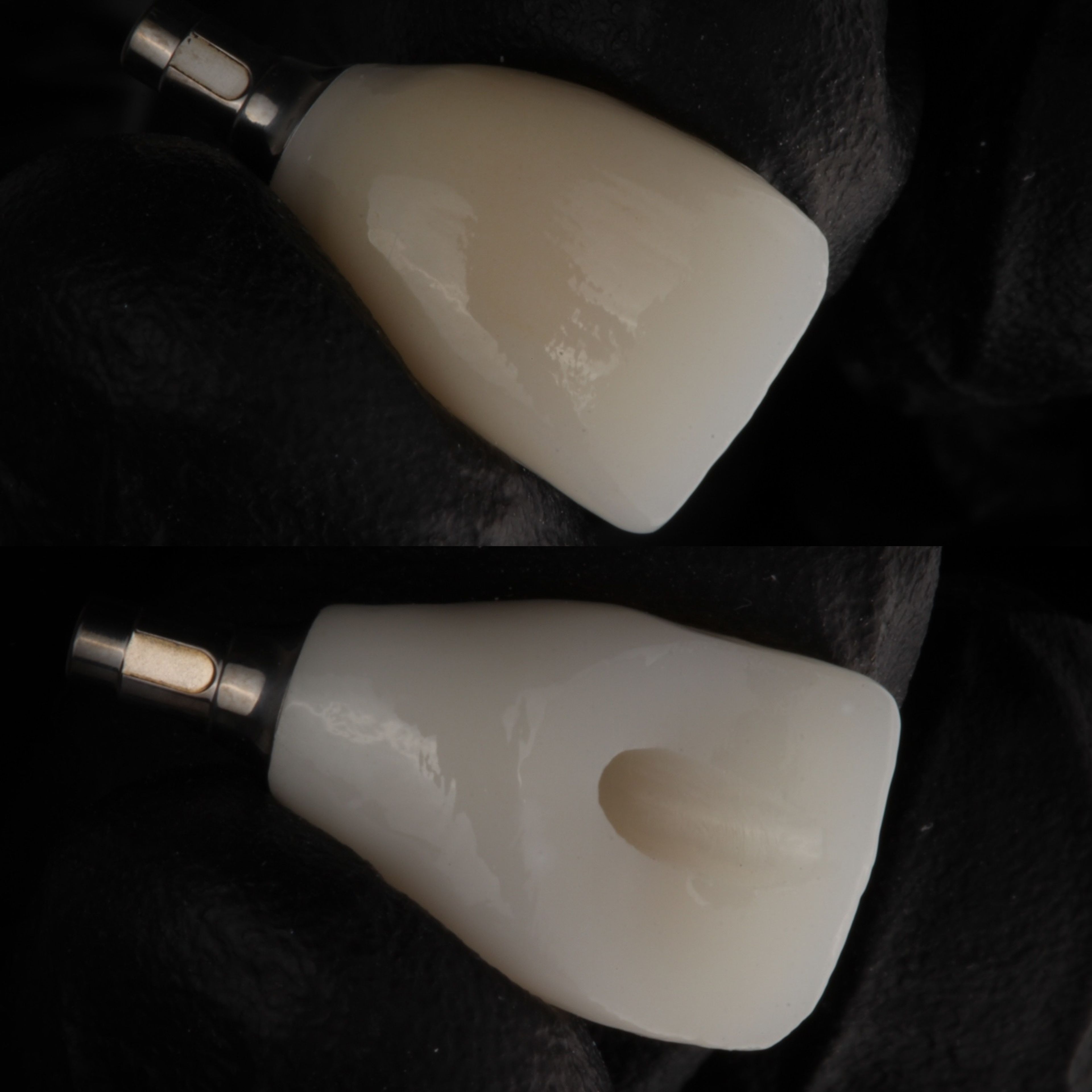 Custom implant crown on abutment showing precise craftsmanship