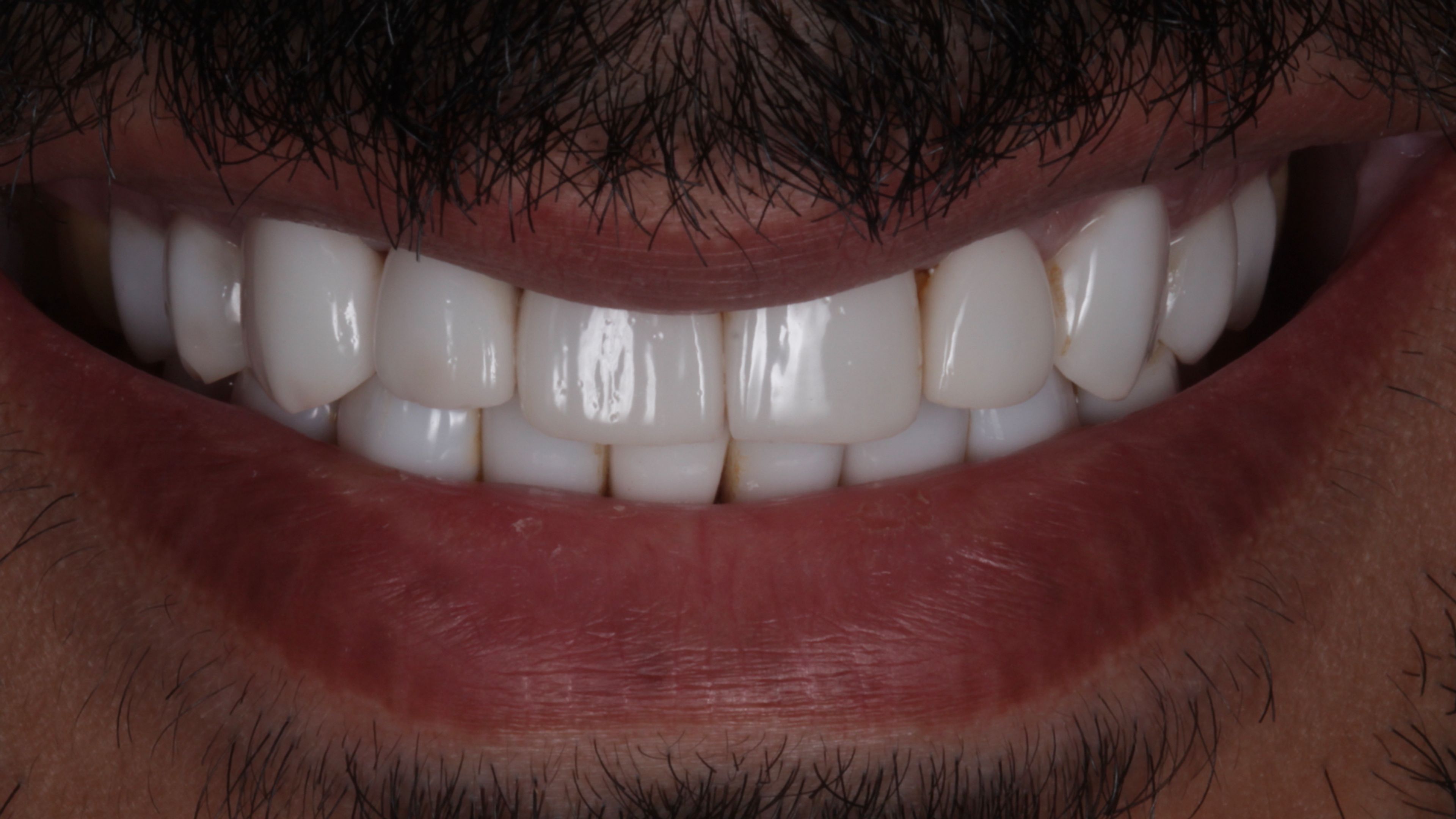 Smile with twenty porcelain veneers — uniformly bright and monochromatic, lacking the subtle variation in shade, shape, and translucency of natural teeth