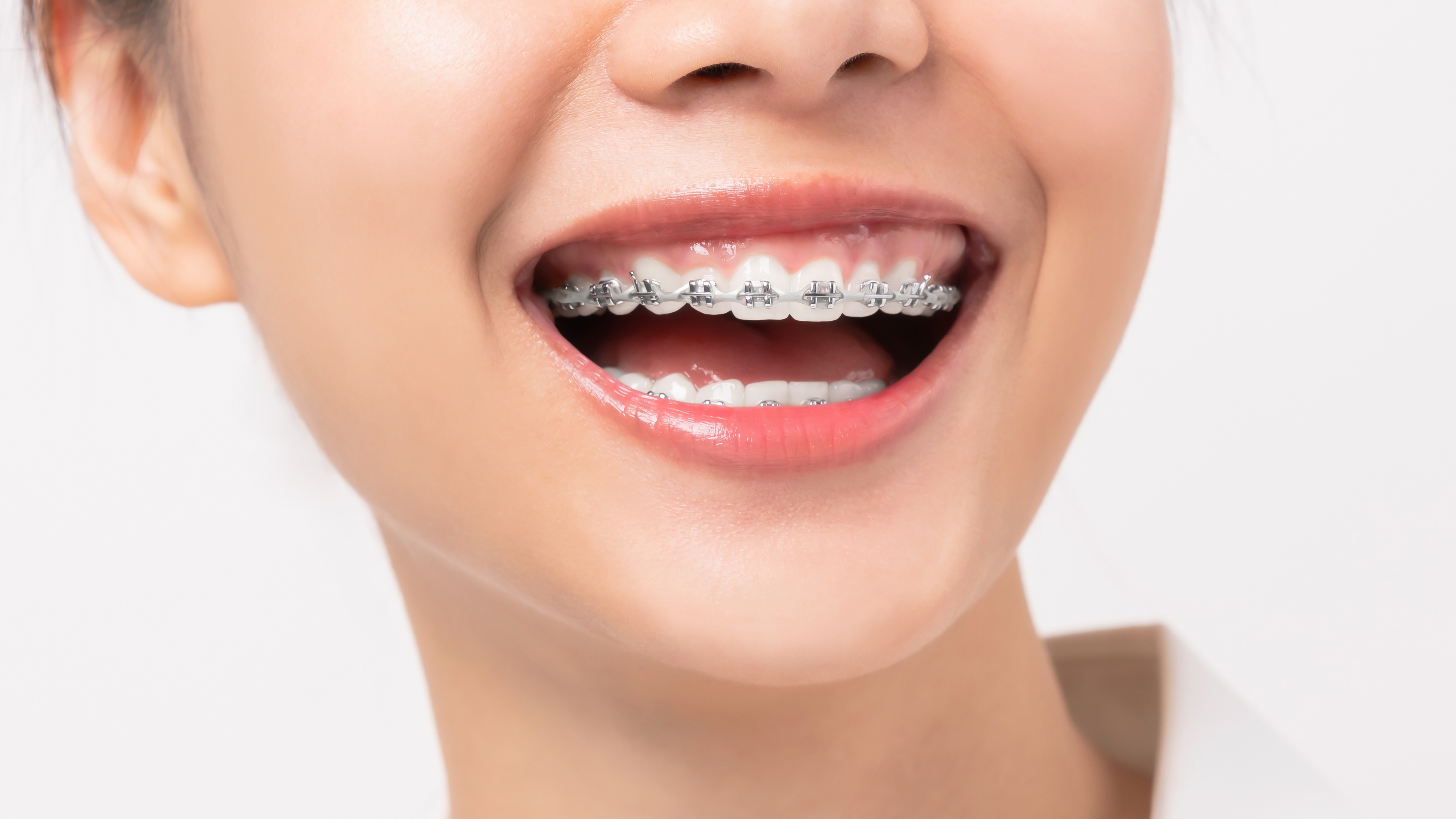 Braces & Orthodontics before and after — specialist dental care at Transcend Dentistry Vancouver