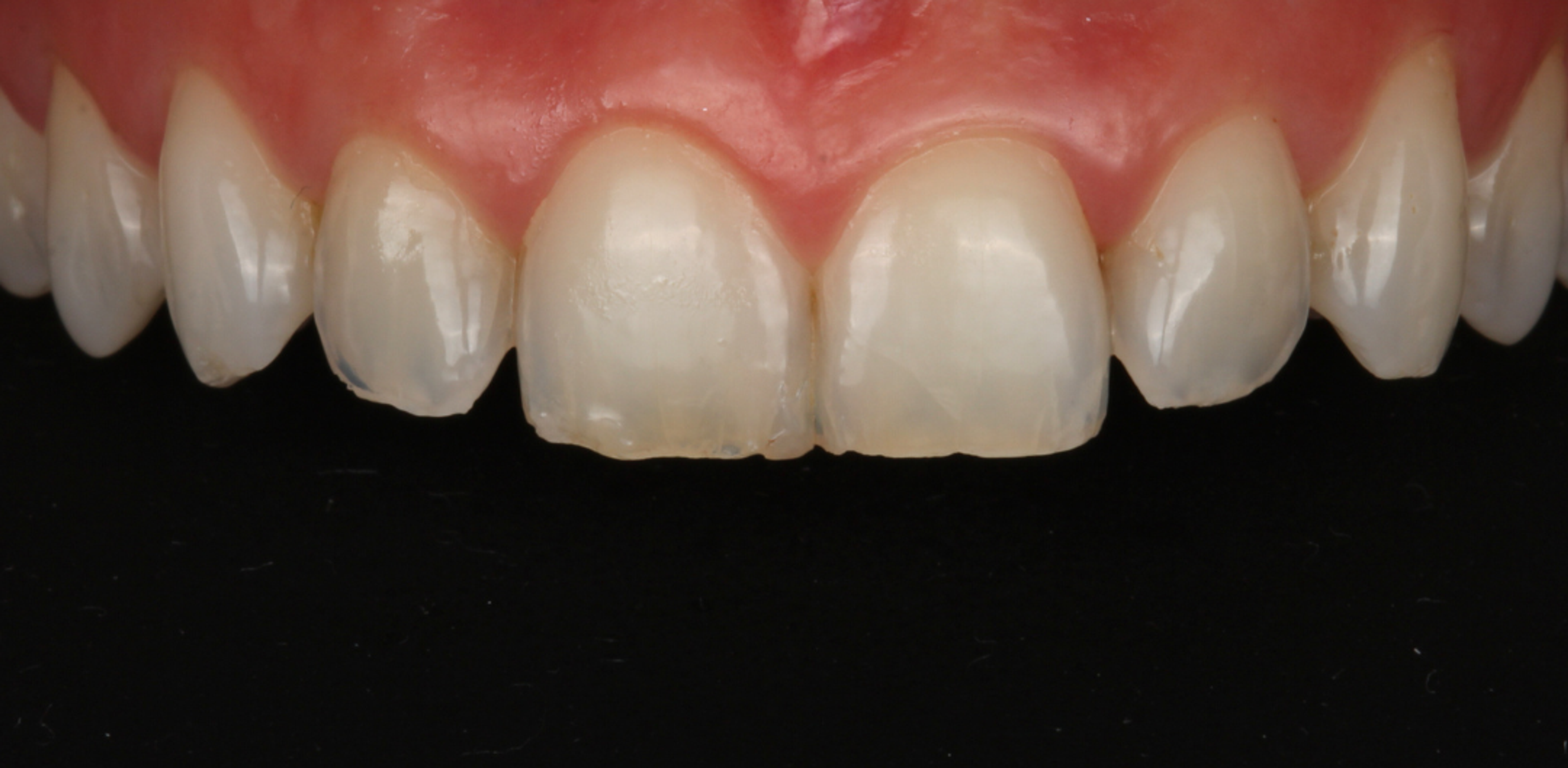 Close-up of upper front teeth before treatment — chipped, worn incisal edges and uneven proportions