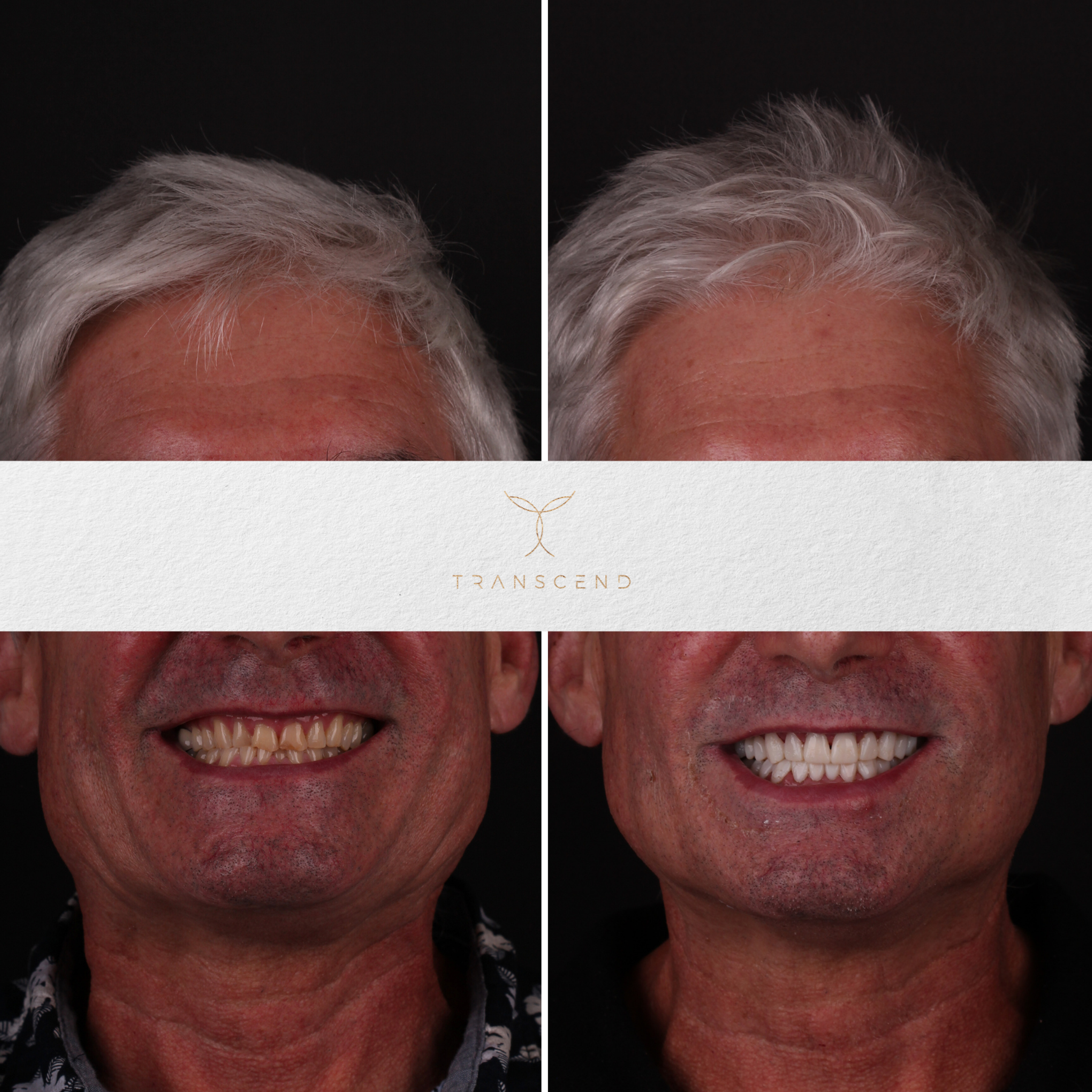 Smile Transformation 6