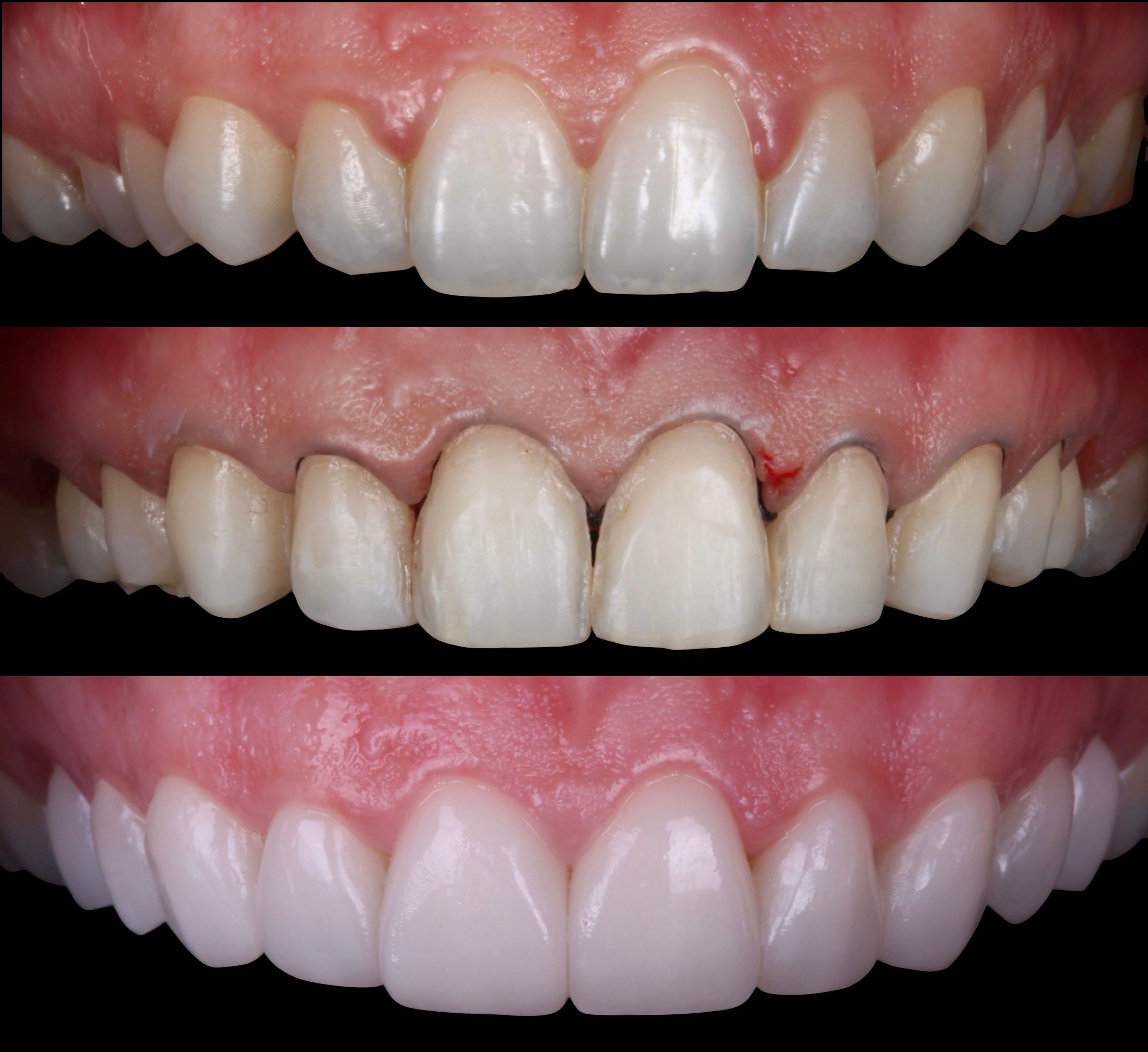 Three-stage progression of a minimal-prep porcelain veneer case at Transcend Specialized Dentistry — before treatment, after gentle enamel-only preparation, and the final bonded result