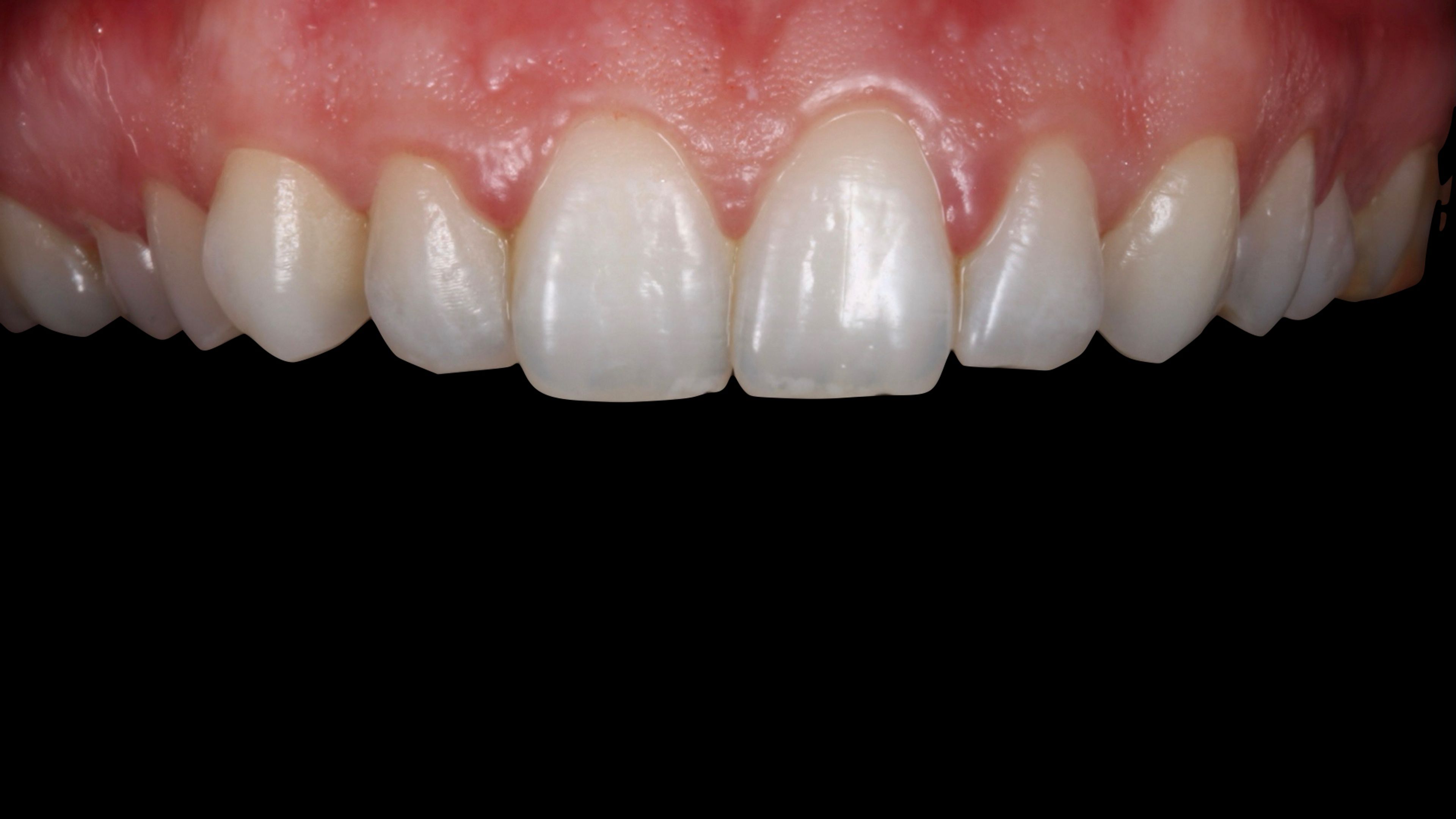 Front teeth before minimal-prep porcelain veneers