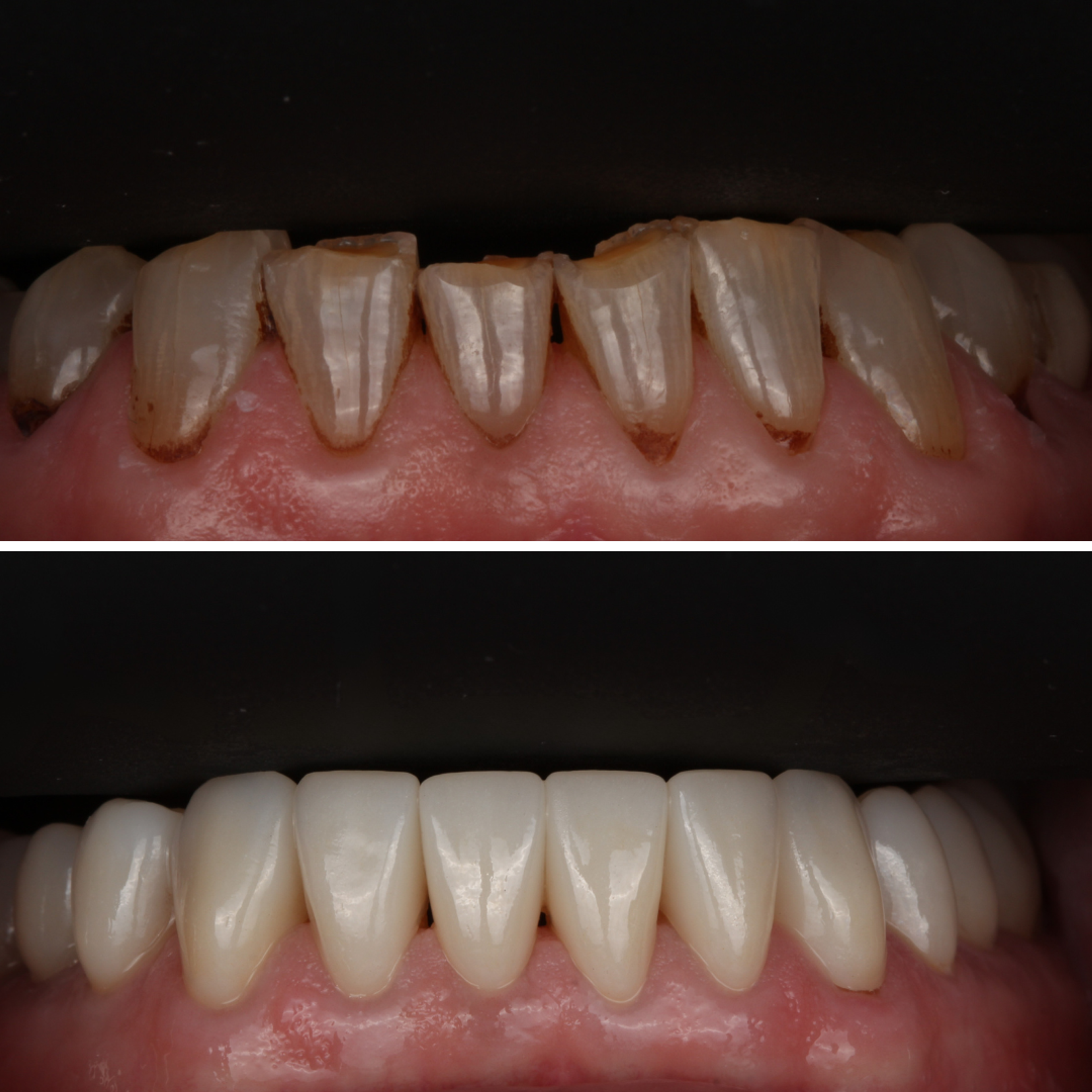 Full Mouth Reconstruction — Lower Arch — before and after