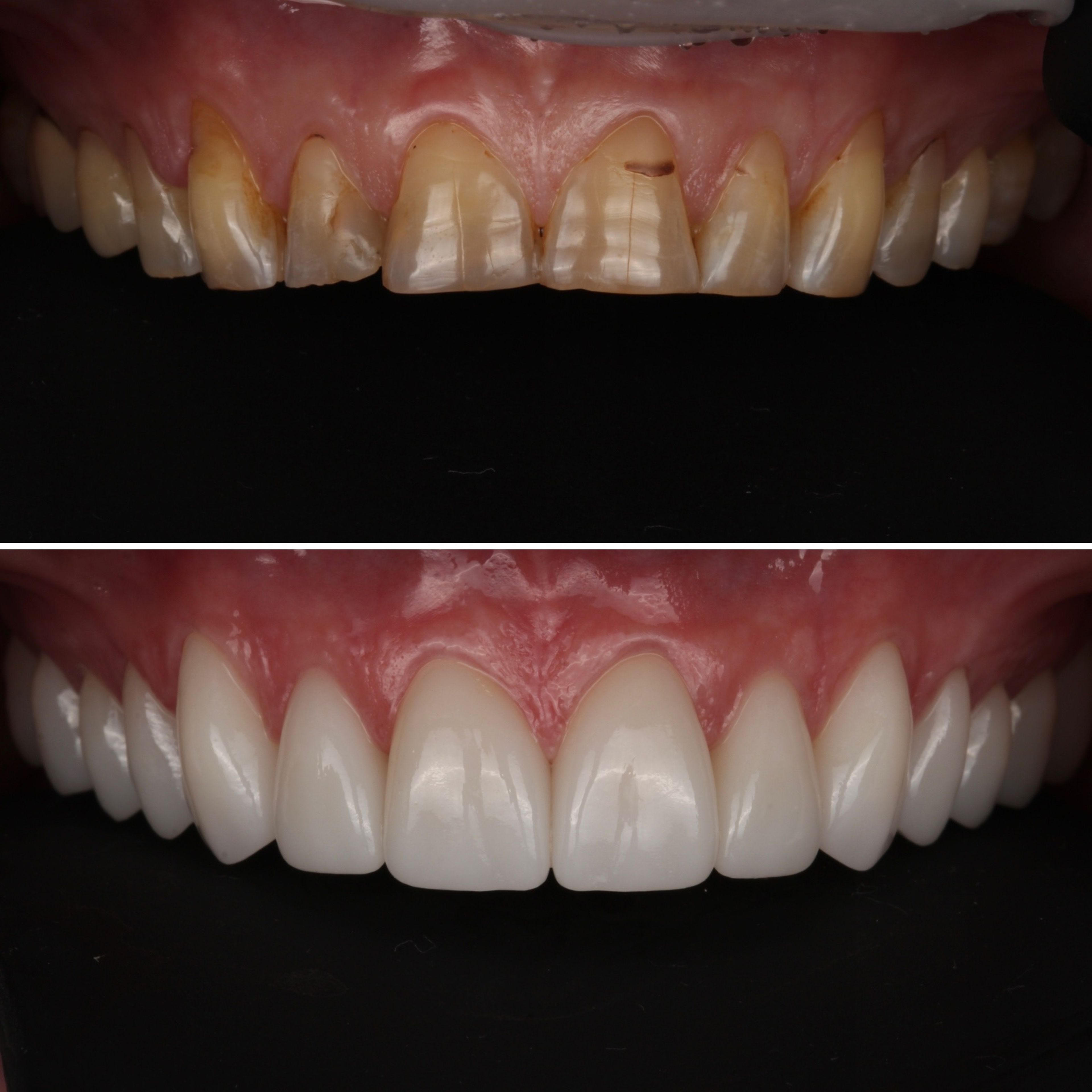 Full Mouth Reconstruction before and after - prosthodontist Vancouver - Transcend Dentistry