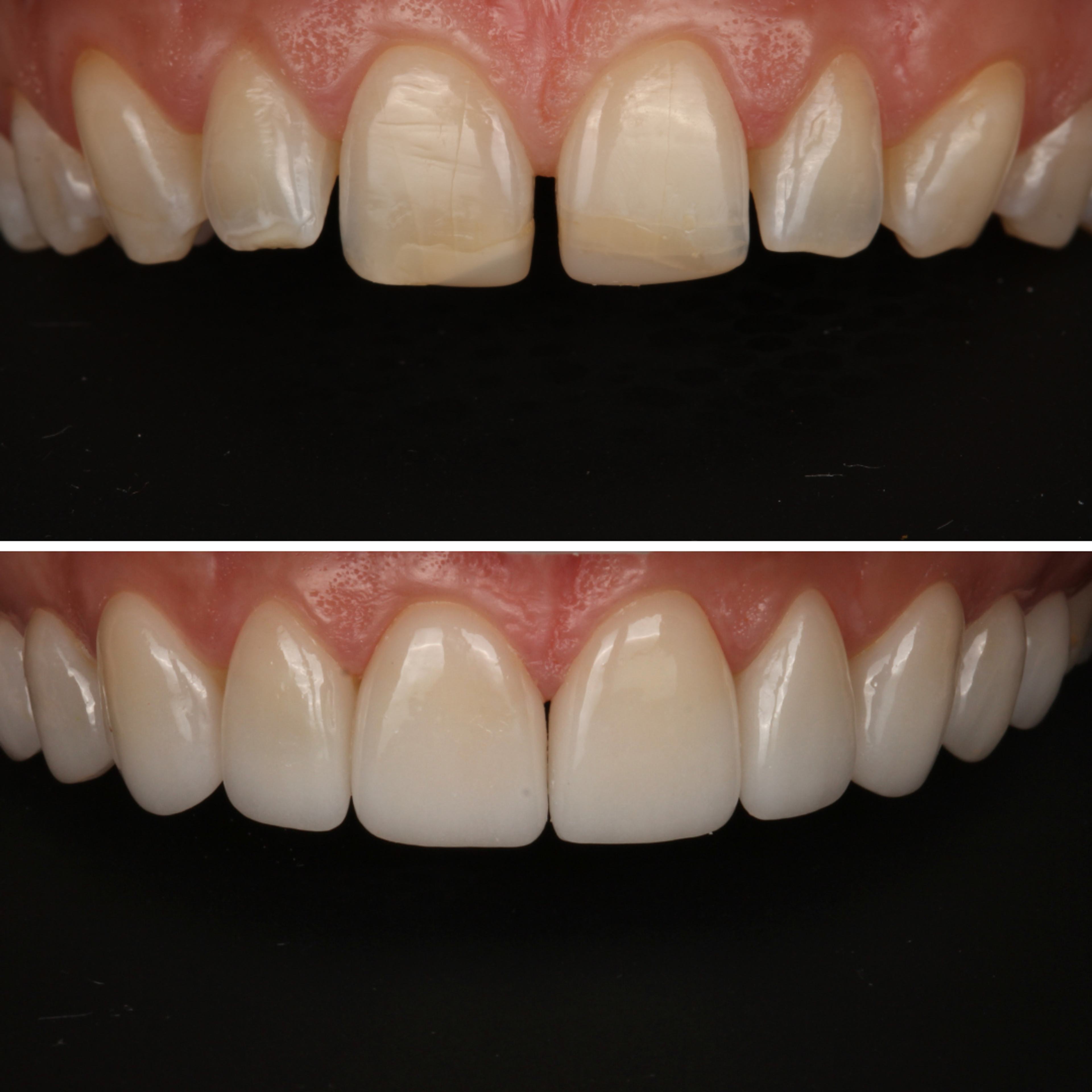 No-Prep Veneers — Clinical Detail — before and after