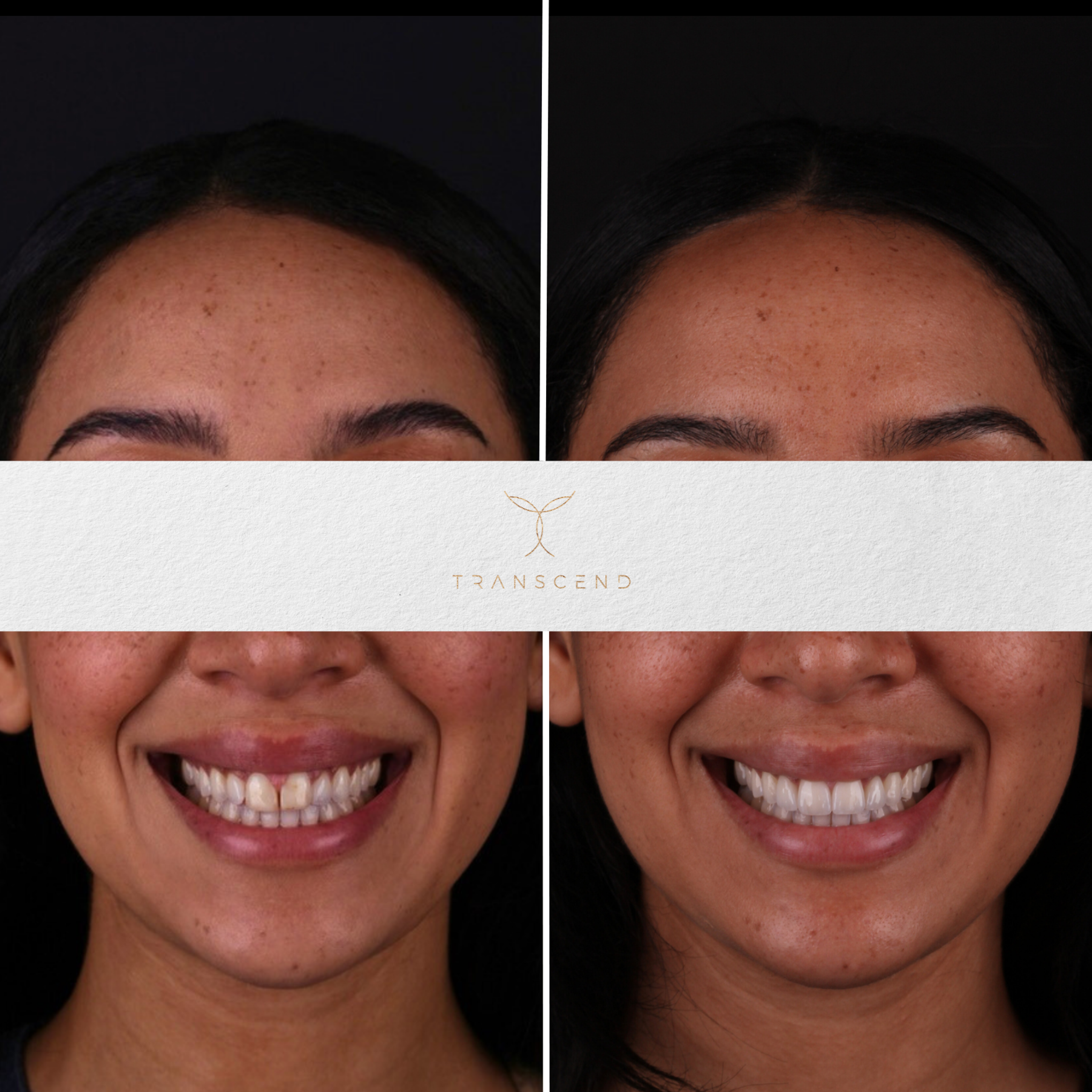 Smile Transformation 5