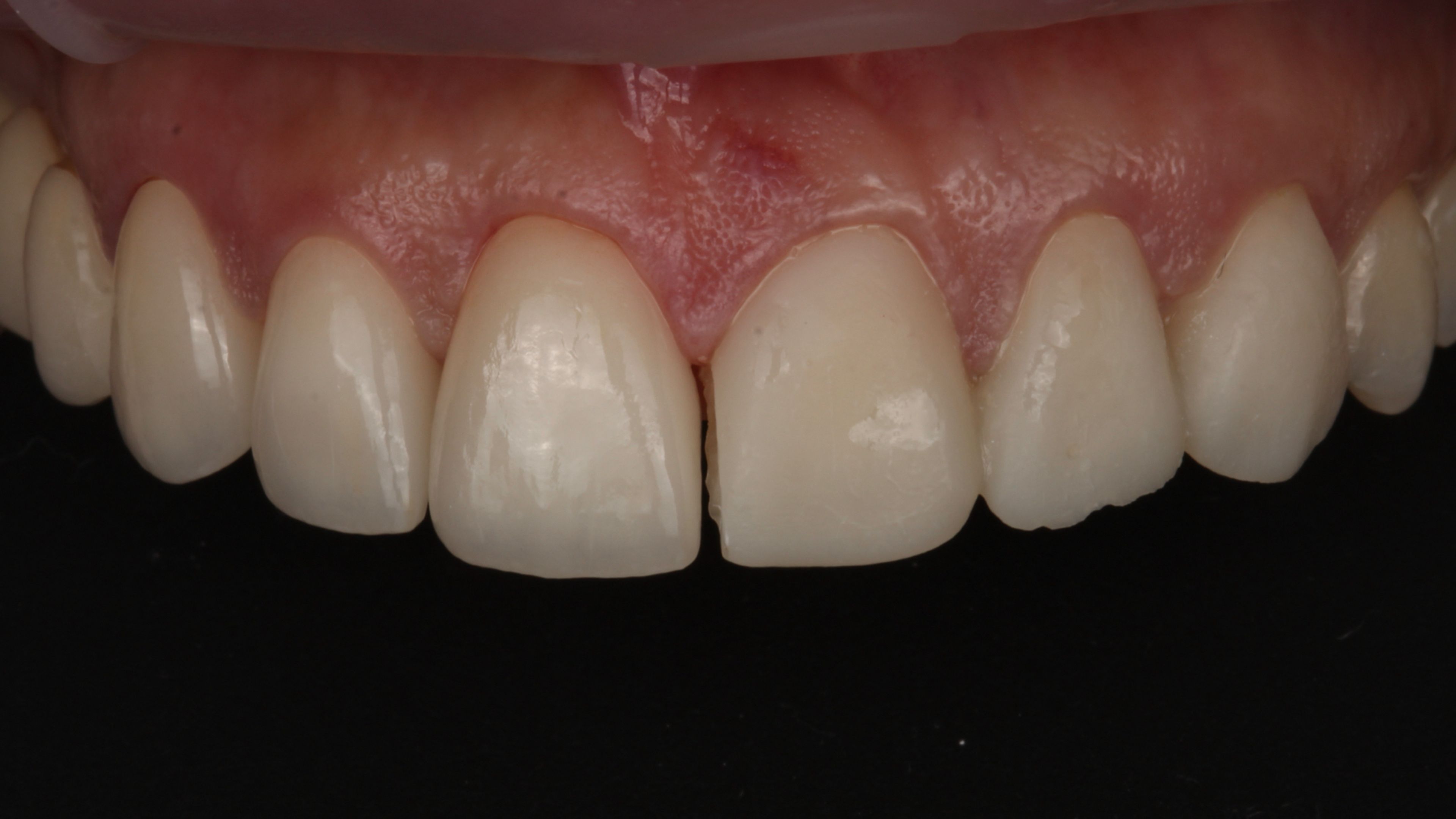 Try-in moment with the prepared teeth and final porcelain veneers placed for evaluation before bonding