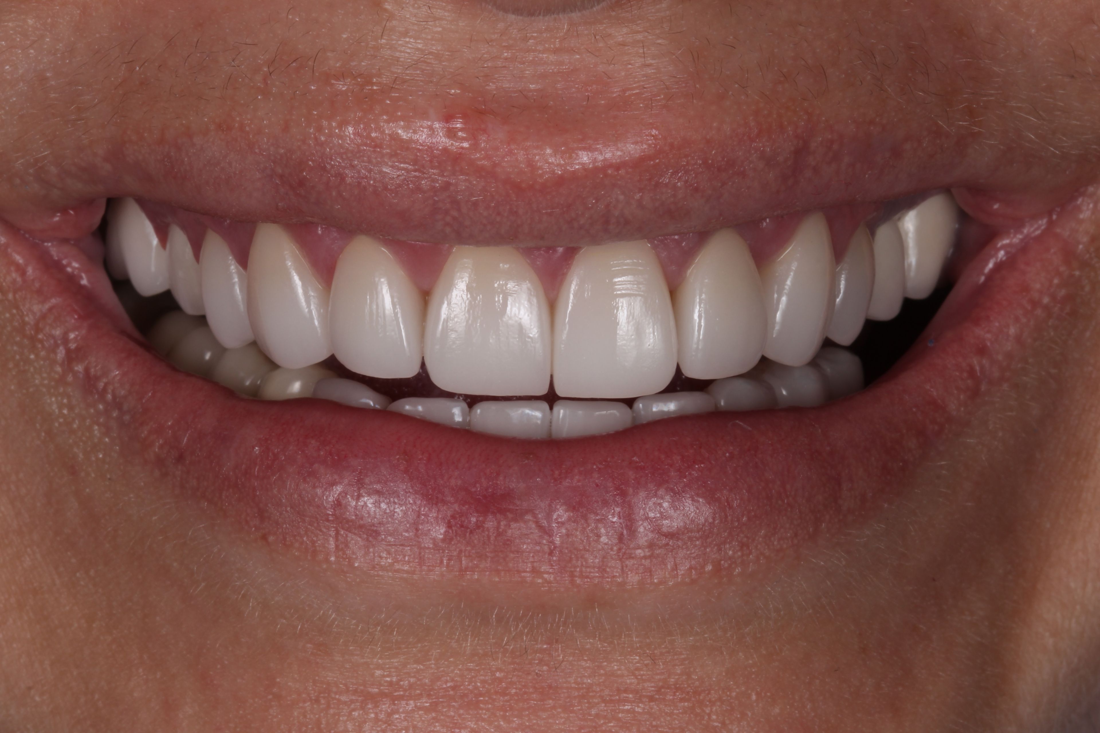 The same smile after the redo — new porcelain veneers with precisely fitting margins, calm healthy gums, and more natural aesthetics